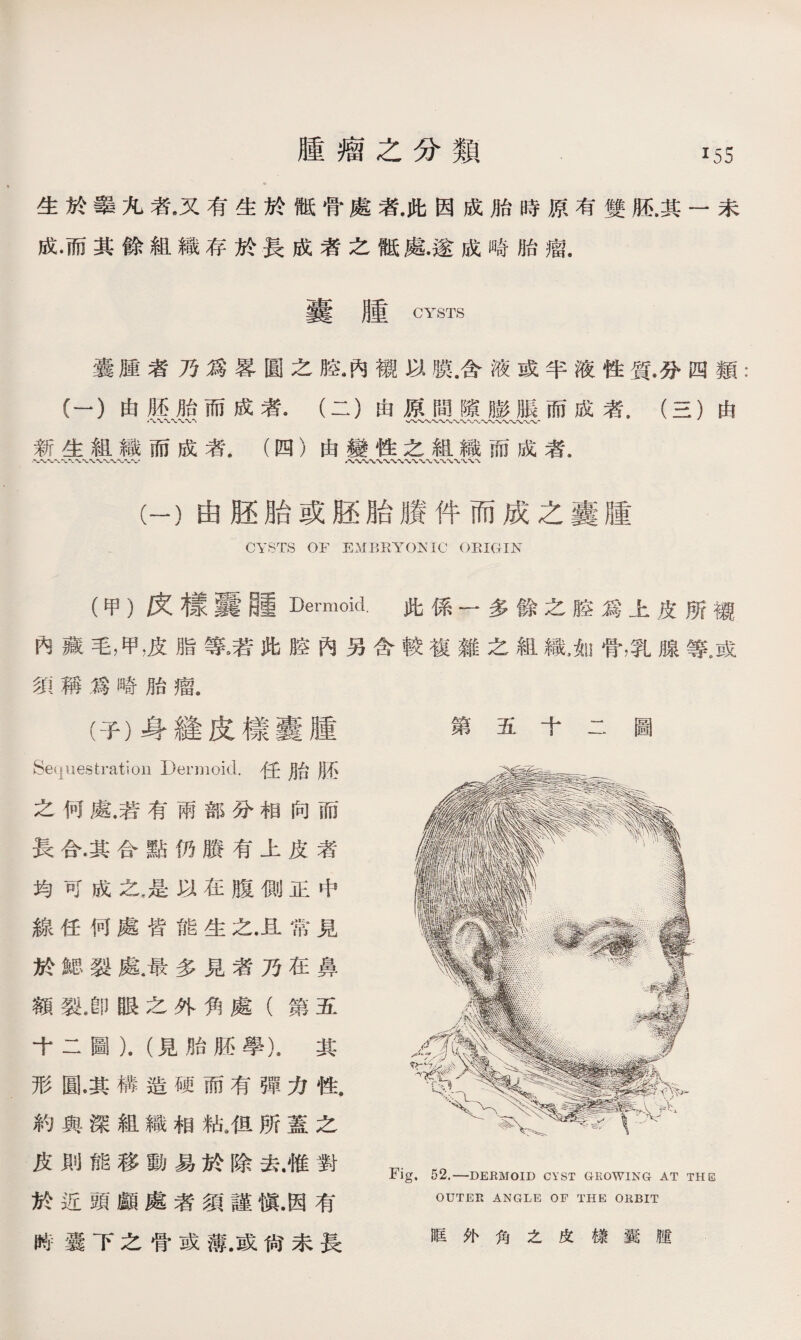 生於舉九者•又有生於骶骨處者.此因成胎時原有雙胚.其一未 成•而其餘組織存於長成者之骶處.遂成畸胎瘤. 囊腫 CYSTS 囊腫者乃爲畧圓之胳•內襯以膜.含液或半液性質.分四類: (一）由胚胎而成者•（二）由原間隙膨脹而成者.（三）由 八、〜〜〜〜' v/V〜〜〜〜〜〜〜〜〜〜〜'〜〜〜〜〜产 新生組織而成者.（四）由變性之組織而成者. 〜〜、、〜〜〜〜-wW 八〜〜、〜〜〜、〜〜〜〜〜〜、、〜'、 (一）由胚胎或胚胎賸件而成之囊腫 CYSTS OF EMBRYONIC ORIGIN (甲）庆樣囊_ dermoid.此係一多餘之腔爲上皮所襯 內藏毛，甲，皮脂等老此腔內另含較複雜之組織，如骨，乳腺等，或 須稱爲畸胎瘤. (子）身縫皮樣囊腫 Sequestration Dermoid•任月台月石 之何處.若有兩部分相向而 長合.其合點仍賸有上皮者 均可成之，是以在腹側正中 線任何處皆能生之.且常見 於鰓裂處.最多見者乃在鼻 額裂8卽眼之外角處（第五 十二圖）.（見胎胚學).其 形圓•其構造硬而有彈力性. 約與深組織相粘9伹所蓋之 皮則能移動易於除去.惟對 於近頭顱處者須謹愼.因有 時囊下之骨或薄.或尙未長 第五十二圖 Fig. 52.一DERMOID CYST GROWING AT THB OUTER ANGLE OF THE ORBIT 眶外角之皮樣囊腫