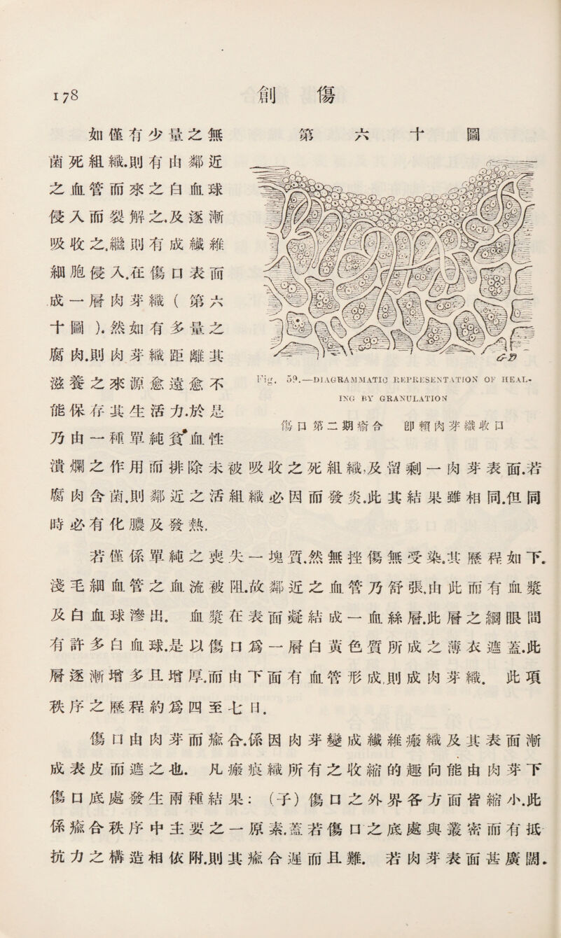 如僅有少量之無 菌死組織.則有由鄰近 之血管而來之白血球 侵入而裂解之.及逐漸 吸收之.繼則有成纖維 細胞侵人在傷口表而 成一層肉芽織（第六 十圖）.然如有多量之 腐肉.則肉芽織距離其 滋養之來源愈遠愈不 能保存其生活力.於是 乃由一種單純貧•血性 傷卩第二期瘉合 卽賴肉芽織取口 潰爛之作用而排除未被吸收之死組織，及留剩一肉芽表面.若 腐肉含菌.則鄰近之活組織必因而發炎，此其結果雖相同.佴同 時必有化膿及發熟， 若僅係單純之喪失一塊質.然無挫傷無受染8其歷程如下. 淺毛細血管之血流被阻•故鄰近之血管乃舒張4由此而有血漿 及白血球滲出。血漿在表而凝結成一血絲層.此層之綱眼間 有許多白血球•是以傷D爲一層白黃色質所成之薄衣遮蓋.此 層逐漸增多且增厚，而由下面有血管形成,則成肉芽織.此項 秩序之歷程約爲四至七曰. 傷口由肉芽而瘉合.係因肉芽變成纖維瘢織及其表面漸 成表皮而遮之也.凡瘢痕織所有之收縮的趣向能由肉芽下 傷口底處發生兩種結果：（子）傷口之外界各方面皆縮小.此 係瘉合秩序中主要之一原素.蓋若傷口之底處與叢密而有抵 抗力之構造相依附.則其瘉合遲而且難.若肉芽表面甚廣闊.