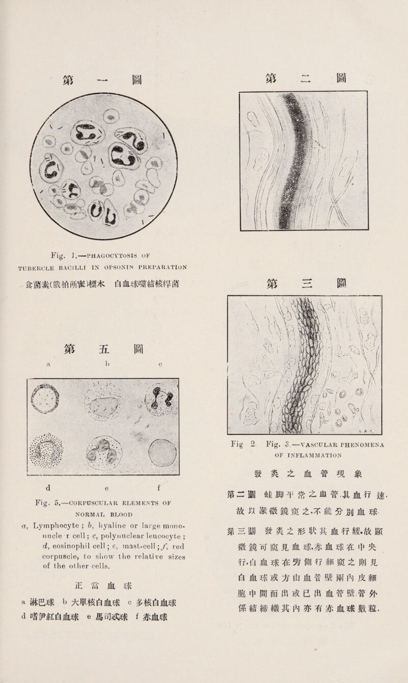 Fig. J.一PHAGOCYTOSIS OF TUBERCLE BACILLI IN OPSONIN PREPARATION 食菌素(戕拍所蜜)標本白血球噬結核桿菌 第五圖 d e f Fig. 5,—CORPUSCULAR ELEMENTS OF NORMAL BLOOD a, Lymphocyte ; b, hyaline or large mono- nucle r cell; c, polynuclear leucocyte ; d, eosinophil cell ; e, mast-cell; red corpuscle, to show tlie relative sizes of the other cells. 正當血球 a淋巴球b大單核白血球c多核白血球 d嗜尹紅白血球e馬司忒球f赤血球 第二圖 第三圖 第二圖蛙脚平常之血管.其血行逑 故以顯微鏡窺之•不能分別血球. 第三D發炎之形狀其血行緩•故顯 微鏡可窺見血球.赤血球在中央 行•白血球在旁側行細窺之則見 白血球或方由血管壁兩內皮細 胞中間而出或已出血管壁.管外 係結締織其內亦有赤血球數粒.