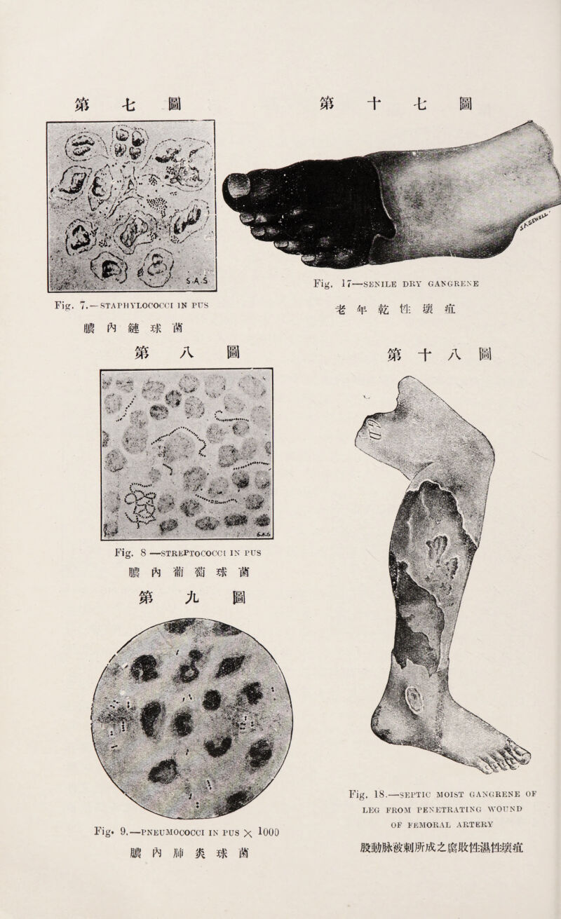 第七圖 第 七 圖 Fig. 7. —STAPHYLOCOCCI IN PUS 膿內鏈球菌 第八圖 Fig. 8 —STREPTOCOCCI IN PUS 膿內葡萄球菌 第九圖 Fig. 9.一pneumococci in pus x ^000 膿內肺炎球菌 Fig. 17—SENILE DRY GA1SGRENE 老年乾性壤疽 第 A圖 Fig. 18.—SEPTIC MOIST GANGRENE OF LEG PROM PENETRATING WOUND OF FEMORAL ARTERY 股動脉被剌所成之腐敗性濕性瓌疽