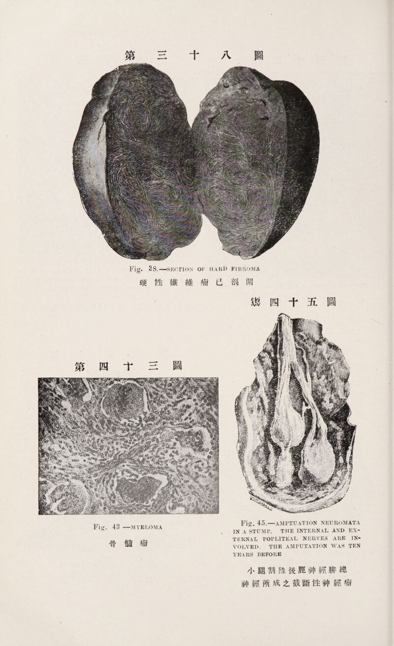 Fig. 43 —MYELOMA 骨髓瘤 Fig. 4d.一AMPTUATION NEUROMATA IN A STUMP. THE INTERNAL AND EX¬ TERNAL POPLITEAL NERVES ARE IN¬ VOLVED. THE AMPUTATION WAS TEN YEARS BEFORE 小腿割除後脛神經腓總 神經所成之截斷性神經瘤