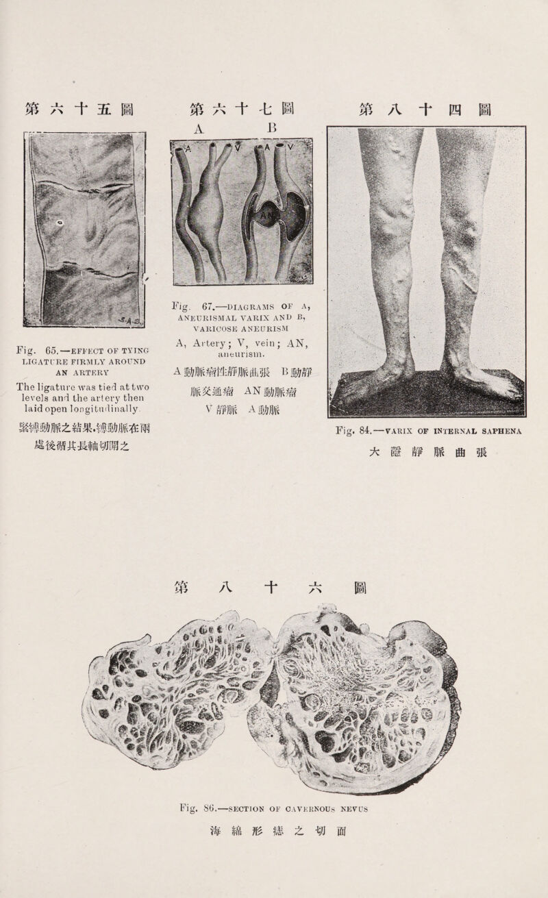 第六十五圖 Fig. 65.—EFFECT OF TYING LIGATURE FIRMLY AROUND AN ARTERY The ligature was tied at two levels and the artery then laid open longitudinally. 繁縛動脈之結果•縛動脈在兩 處後循其县軸切開之 第六十七圖 A B Fig. 67.—DIAGRAMS OF A, ANEURISMAL YARIX AND B, VARICOSE aneurism A, Artery; V, vein; AN, aneurism. A動脈瘤性靜脈曲張B動靜 脈交通瘤AN動脈瘤 V靜脈A動脈 第八十四圖 Fig. 84.—VARIX OF internal saphena 大隱靜脈曲張 海綿形痣之切面