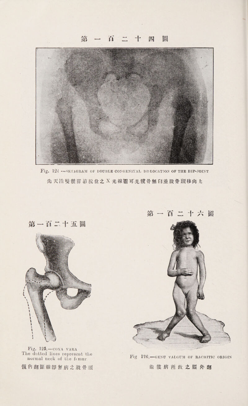 Fig. 12-! —SKIAGRAM or DOUBLE CONGENITAL DISLOCATION OF THE HIP-JOINT 先灭性雙髋關筘脫位之X光線圖可，見髖骨無臼並股骨頭移向上 第一百二十五圖 第一百二十六圖 Fig. 125.—COXA VARA The dotted lines represent the normal neck of the f( mur 髋內翻謹線卽無病之股骨頸 Fig 126.一GENU VALGUM OF RACHITIC ORIGIN 徇僂病所致之膝外翻