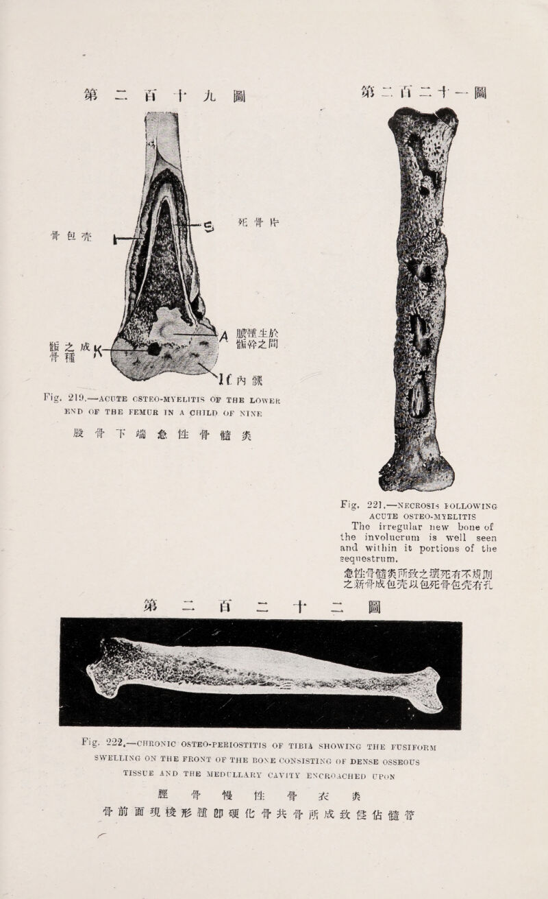 第 B 十九圖 第二ft二十一圖 死骨申 膿植生於 骺幹之間 1 f內譏 Fig. 219.—ACUTE OSTEOMYELITIS OF THE LOWER END OF THE FEMUR TN A CHILP OP NINE 股骨下端急性骨髓炎 Fig, 22] .—NECROSIS FOLLOWING ACUTE OSTEO-M1ELITIS The irregular new bone of the involucrum is well seen and within it portions of the sequestrum. 急t生骨髓爽两致之瓌死有不規則 之新骨成包壳以包死骨包壳有孔 tig, 22'24—CHRONIC OSTEO-PEKIOSTITIS OF TIETA SHOWING THE FUSIFORM SWELLING ON THE FRONT OF THE BONE CONSISTING OF DENSE OSSEOUS TISSUE AND THE MEDULLARY CAVITY ENCROACHED UPON 脛 骨 慢 性 骨 衣 炎 骨前面現梭形腿卽硬化骨共骨所成致侵佔髓管