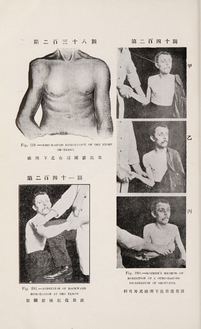 第二Ti三十八圖 Fig. 238.—SUBCORACOID DISLOCATION OF THE EIGHT SHOULDER 喙突下之右卮關節脫位 第二百四十一圖 Fig. 241.—REDUCTION OF BACKWARD DISLOCATION AT THK ELBOW 肘關節後脫愎位法 第二百四十圖 Fig* 240.一KOCHER’S METHOD OF REDUCTTON OF A SUBCOKACOID 1)1.^LOCATION OF SHOULDER 科付耳氏喙突下脫位復位法