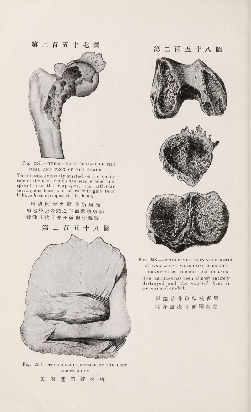 第二百五f七圖 ■Fig. 257.—THBERCULOUS DISEASE OF THIC HEAD AND NECK OF THE FI'.MUR The disease evidently started on the under side of the neck which lias been eroded and spread into the epipljpis，the articular cartilage is loose a11d necrotic fragments of it have been stripped off the boue. 患結核病之股骨頭興頸 病起於股#頸之下面致頓與骺 被蝕其軟骨亦死而與骨脫離 第二白' 五十九圖 Fig. 259. — TUBERCULOUS DISEASE OF THE LEFT ELBOW JOINT 左时關節結核病 第二百五十八圖 Fig. 258.—BONES ENTERING INTO FORMATIO OF K^EE-JOINT WHICLr HAS BEEN DIS¬ ORGANIZED BY T[JBKRCCLOUS DISEASE The cartilage has been almost entirely destroyed and the exposed bone is carious and eroded, 膝關節骨被結核所壤 軟骨盡壤骨面爾而蝕