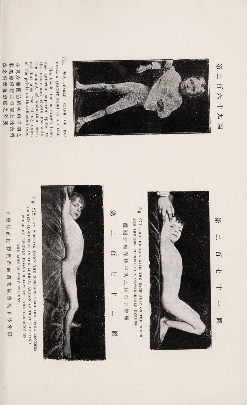 铖[1切訃4^菌 铖：：lInier4 Fig, 26.^—EARLY STAGE OF HIP DISEASE (RIGHT SIDE}. IN A CHILI>- The brek: line is drawnM5rom 03® anterior superior spine tp the other ami shows not only the amount of pcr-Gcoct-iml pres- ent but also the tiltinOQd.owu of the pelvis on the affected side. 夺洚掛譴翻斡龜脔澈-ifflMN- 浑链粦镝馘u tl^h-露撕葚 斡N-窣襻涔鍊舄H-竽诞 Fig. 271 1HIP 2SE‘VS« 名rm TME BACK： flat ox THSCOUCH AyD THE LSG FLrt>!lBD TO A GONSIDHnABLE DEGFrEB _ IM ifm硪辟书PN 窝siT 结SI 铖 一一 rv Fig. 272. —ON PRESSING DOWN THE DISKASFb 2MB THE SPINE BKCOMES AKOHED (LOKDOSIS) IN THE LUMBAR REGION SO THAT THE HAND BULD BK KHAI〕1LY FASSliD BKLOW IT. THR EVERSSN OF TH3 LISB IS 4rtl?3Y SVIDBZT. F菏if菏涅獨盖&否驾斛頸垚遄^辯孕馘