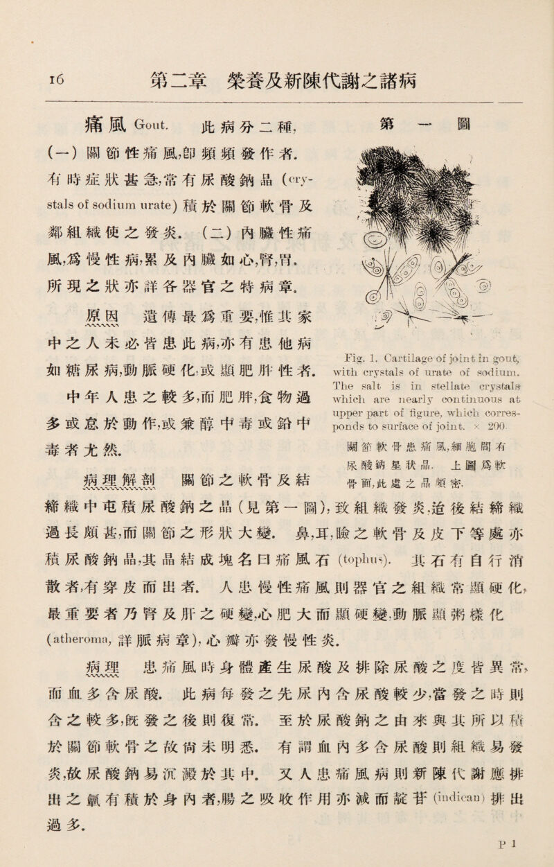 痛風Gout. 此病分二種， 第一圖 (一）關節性痛風，卽頻頻發作者. 有時症狀甚急，常有尿酸鈉晶（町- stals of sodium urate)積於關節軟骨及 鄰組織使之發炎.（二）內臟性痛 風，爲慢性病，累及內臟如心，腎，胃. 所現之狀亦詳各器官之特病章， 原因 遺傳最爲重要，惟其家 中之人未必皆患此病，亦有患他病 如糖尿病，動脈硬化，或顯肥胖性者. 中年人患之較多，而肥胖，食物過 多或怠於動作，或兼醇中毒或鉛中 毒者尤然. 病理解剖 關節之軟骨及結 Fig. 1. Cartilage of joint in goufe, with crystals of urate of sodium. The salt is in stellate crystals- which are nearly contimious at upper part of figure, which corres¬ ponds to surface of joint, x 20(). 關節軟骨患痛風，細胞間有 尿酸钠星状晶.上圖爲軟 骨面，此處之晶頬密. 締織中屯積尿酸鈉之晶（見第一圖），致組織發炎•适後結締織 過長頗甚，而關節之形狀大變.鼻，耳，瞼之軟骨及皮下等處亦 積尿酸鈉晶，其晶結成塊名曰痛風石(tOplllH).其石有自行消 散者，有穿皮而出者.人患慢性痛風則器官之組織常顯硬化， 最重要者乃腎及肝之硬變，心肥大而顯硬變.動脈顯粥樣化 (atheroma,詳脈病章），心瓣亦發慢性炎. 病理患痛風時身體產生尿酸及排除尿酸之度皆異常， 而血多含尿酸.此病每發之先尿內含尿酸較少，當發之時則 含之較多，旣發之後則復常.至於尿酸鈉之由來與其所以積 於關節軟骨之故尙未明悉.有謂血內多含尿酸則組織易發 炎，故尿酸鈉易沉澱於其中.又人患痛風病則新陳代謝應排 出之氯有積於身內者，腸之吸收作用亦減而靛苷和dican)排出 過多.