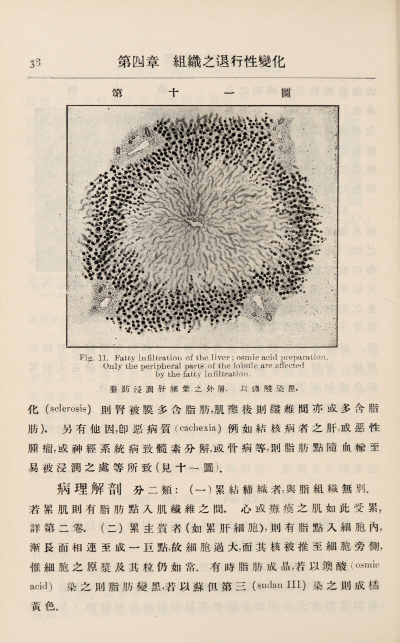 33 第四章組織之退行性變化 第 摩， :欲 W4 Fig. 11. Fatty infiltration of the liver ; osmic acid preparation. Only the peripheral parts of the lobule are affected by the fatty infiltration. 脂肪浸潤肝細葉之外層.以鏤酸染黑• 化(sclerosis)則腎被膜多含脂肪，肌癱後則纖維間亦或多含脂 肪).另有他因，卽惡病質（cachexia)例如結核病者之肝滅惡性 腫瘤，或神經系統病致髓素分解，或骨病等，則脂肪點隨血輸至 易被浸潤之處等所致（見十一圖). 病理解剖分二類：（一）累結締織者，與脂組織無別， 若累肌則有脂肪點入肌纖維之間•心或癱瘓之肌如此受累， 詳第二卷.（二）累主質者（如累肝細胞)，則有脂點入細胞內， 漸長而相連至成一巨點，故細胞過大，而其核被推至細胞旁側， 惟細胞之原漿及其粒仍如常.有時脂肪成晶，若以燠酸(⑽mic acid)染之則脂肪變黑，若以蘇但第三(sudan III)染之則成橘 黃色.