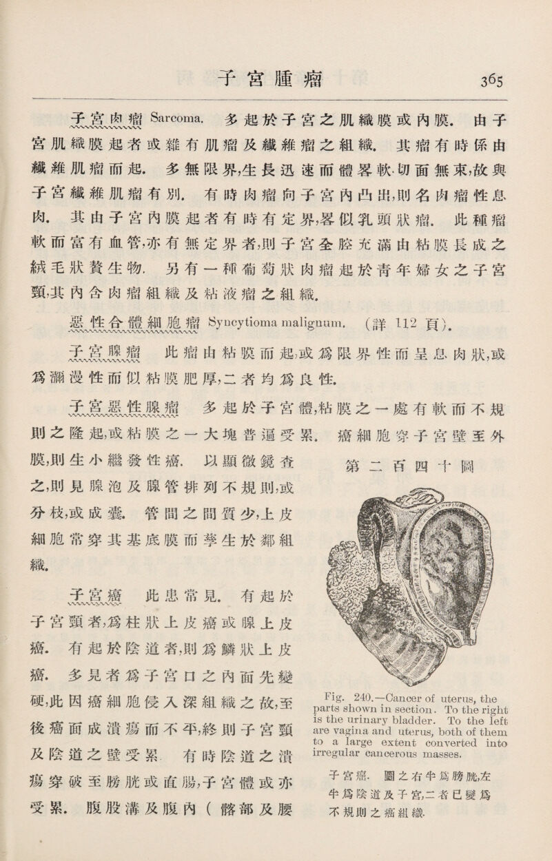 子宫腫瘤 3^5 Sarcoma*多起於子宮之肌織膜或內膜•由子 宫肌織膜起者或雜有肌瘤及纖維瘤之組織.其瘤有時係由 纖雜肌瘤而起•多無限界，生長迅速而體畧軟。切面無束，故與 子宮纖維肌瘤有別.有時肉瘤向子宫內凸出，則名肉瘤性息 肉.其由子宫內膜起者有時有定界，g似乳頭狀瘤.此種瘤 軟而富有血管，亦有無定界者，則子宫全腔充滿由粘膜長成之 絨毛狀贅生物.另有一禪:葡萄狀肉瘤起於靑年婦女之子宮 頸，其內含肉瘤組織及粘液瘤之組織， 惡性合體細胞瘤Syocytioma maligrmm.(詳II2頁）. 此瘤由粘股而起，或爲限界性而呈息肉狀，或 爲漏漫性而似粘膜肥厚，二者均爲良性. 多起於子宮體，粘膜之一處有軟而不規 則之隆起，或粘膜之一大塊普遍受累.癌細胞穿子宮壁至外 膜，則生小繼發性癌.以顯微鏡查 之，則見腺泡及腺管排列不規則，或 分枝，或成囊•管間之間質少，上皮 細胞常穿其基底膜而孳生於鄰組 第二百 十圖 織. 子宮癌此患常見.有起於 子宫頸者，爲柱狀上皮癌或腺上皮 癌.有起於陰道者，則爲鱗狀上皮 癌.多見者爲子宫口之內面先變 硬，此因癌細胞侵入深組織之故，至 後癌面成潰瘍而不平，終則子宮頸 及陰道之壁受累.有時陰道之潰 瘍穿破至膀胱或直腸，子宫體或亦 受累.腹股溝及腹內（髂部及腰 Fig. 240.—Cancer of uterus, the parts shown in section. To the right is the urinary bladder. To the left are vagina and uterus, both of them to a large extent converted into irregular cancerous masses. 子宫癌.圖之右半爲膀脫，左 半爲陰道及子宮，二者已變爲 不規則之癌組織.