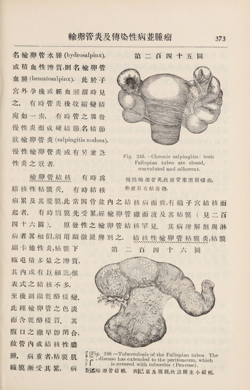 輸卵管炎及傅染性病並腫瘤 名輸卵管水腫(hydrosalpinx). 或積血性滲質，則名輸卵管 血腫（hematosalpinx).此於子 宫外孕後或經血瀦溜時見 之.有時管炎後收縮變結 宛如一'索•有時管之腺發 慢性炎而成硬結節名結節 狀輸卵管炎(salpingitis nodosa). 慢性輸卵管炎或有5]兼急 性炎之狀者. 輸卵管結核 有時爲 結核性粘膜炎.有時結核 第二H四十五圖 -Fig. 245. — Chronic salpingitis : both Fallopian tubes are closed, convoluted and adherent. 慢性輸卵管炎，致兩管塞閉而蟠曲, 外面有粘連物. 病累及其漿膜，此常因骨盆內之結核病而致，有繼子宮結核而 起者•有時腹膜先受累，經輸卵管繳而波及其粘膜（見二百 四十六圖）.原發性之輸卵管結核罕見。其病理解剖與淋 病者畧相似，須用顯微鏡辨別之.結核性輸卵管粘膜炎，粘膜 顯卡他性炎，粘膜下 第二百四十六圖 織屯積多量之滲質， 其內或有巨細胞，惟 表式之結核不多. 至後則顯乾酪樣變. 此種輸卵管之色淡 而含乾酪樣質.其 腹口之饊早卽閉合， 故管內成結核性膿 腫•病重者，粘膜肌 織膜漸受其累.病 • 246 —Tuberculosis of the Fallopian tubes The lsoaso lias extended to the peritoneum, which is covered with tubercles (Penrose). 短墓輸卵管結核.病〖已累及腹膜，致該膜生小結核.