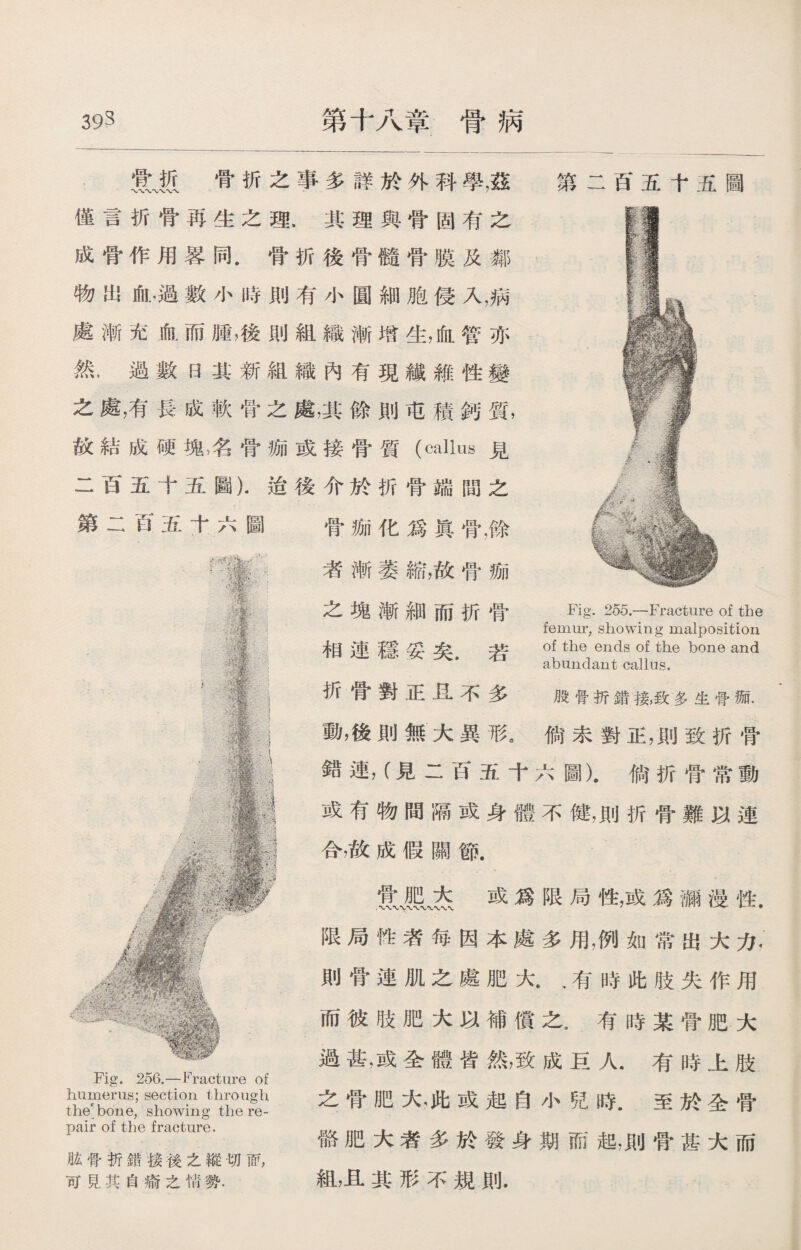 393 第十八章骨病 ®j5 骨折之事多詳於外科學，茲 第二百五十五圖 僅言折骨再生之理.其理與骨固有之 成骨作用畧同.骨折後骨髓骨膜及鄰 處漸充血而腫，後則組織漸增生，血管亦 然.過數日其新組織內有現纖雜性變 之處，有長成軟骨之處，其餘則屯積鈣質， 故結成硬塊名骨痂或接骨質（callus見 二百五十五圖).迨後介於折骨端間之 第二百五十六圖 骨痂化爲眞骨，餘 者漸萎縮，故骨痂 之塊漸細而折骨 相連穩妥矣.若 折骨對正丑不多 Fig. 255.—Fracture of the femur, showing malposition of the ends of the bone and abundant callus. 股骨折錯接，致多生骨湎. 動，後則無大異形。倘未對正，則致折骨 錯連，（見二百五十六圖).倘折骨常動 或有物間隔或身體不健，則折骨難以連 合，故成假關節. 或爲限局性，或爲彌漫性. 限局性者每因本處多用，例如常出大力, 則骨連肌之處肥大.，有時此肢失作用 而彼肢肥大以補償之.有時某骨肥大 物出血.過數小時則有小圓細胞侵入，病 Fig. 256.—Fracture of humerus; section through the bone, showing the re¬ pair of the fracture. 肱骨折錯接後之縱切面， 可見其自瘉之情勢. 過甚，或全體皆然，致成巨人.有時上肢 之骨肥大，此或起自小兒時.至於全骨 骼肥大者多於發身期而起，則骨甚大而 組，且其形不規則.