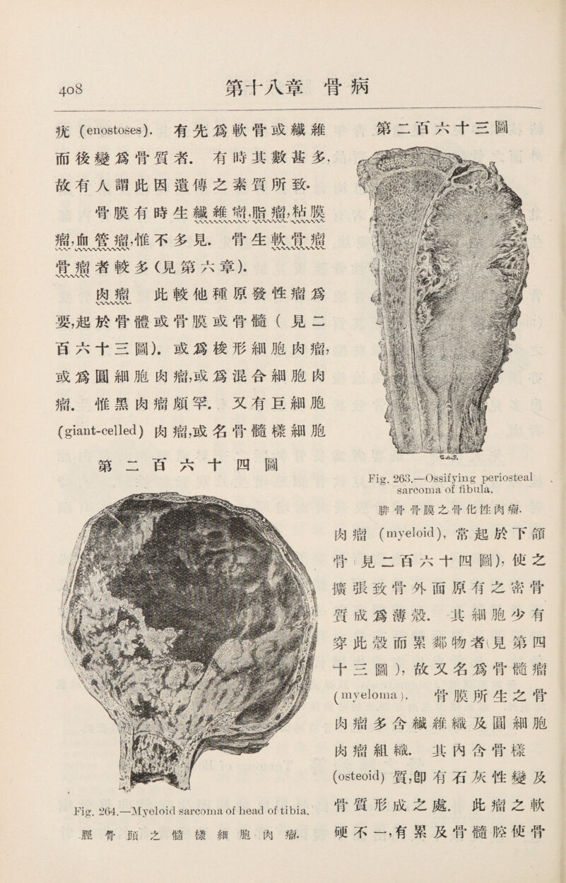 40 8 第十八章骨病 瓣鷄 抚(enostoses).有先爲軟骨或纖維 第二白六十三 腓骨骨膜之骨化性肉瘤. 肉瘤（myeloid)，常起於下頜 骨t見二百六十四圖），使之 擴張致骨外面原有之密骨 質成爲薄殼.其細胞少有 穿此殼而累鄰物者v見第四 十三圖），故又名爲骨髓瘤 (myeloma). 骨膜所生之骨 肉瘤組織.其內含骨樣 (osteoid)質，卽有石灰性變及 Fig. 264.—Myeloid sarcoma of head of tibia.骨 形成之處.此瘤之軟 脛骨頭之髓樣細胞肉瘤. 硬不一，有累及骨髓腔使骨 而後變爲骨質者.有時其數甚多， 故有人謂此因遺傳之素質所致， 骨膜有時生纖維簡，脂瘤，粘膜 .〜〜〜〜〜〜〜 瘤，JftI管瘤，惟不多見.骨生軟骨瘤 cWWW*VW〜、 骨瘤者較多（見第六章). 肉瘤 此較他種原發性瘤爲 Vww 要，起於骨體或骨膜或骨髓（見二 百六十三圖）.或爲梭形細胞肉瘤， 或爲圓細胞肉瘤，或爲混合細胞肉 瘤.惟黑肉瘤頗罕.又有巨細胞 (giant-celled)肉瘤，或名骨髓樣細胞 第二百六十四圖 肉瘤多含糨維織及圓細胞 Fig. 263.—Ossifying periosteal sarcoma of fibula.