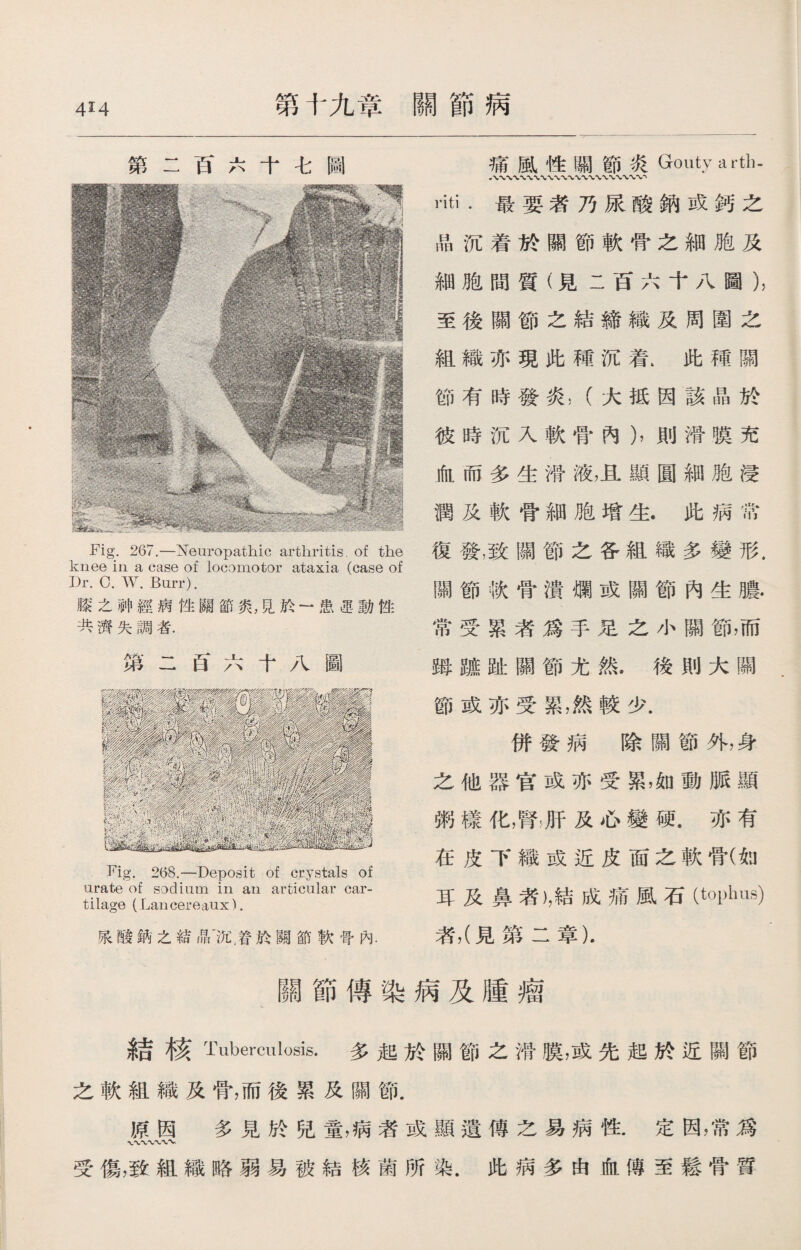 4!4 第十九章關節病 第二百六十七圖 Fig. 267.—Neuropathic arthritis, of the knee in a case of locomotor ataxia (case of Dr. 0. W. Burr). 膝之神經病性關節炎，見於一患迅動性 共濟失調者. 第二百六十八圖 Fig. 2(58.—Deposit of crystals of urate of sodium in an articular car¬ tilage (Lancereaux). m酸鈉之結晶'沉，管於關節軟骨內. 痛風性關節炎Gouty arth- i*iti .最要者乃尿酸鈉或鈣之 晶沉着於關節軟骨之細胞及 細胞間質（見二百六十八圖）， 至後關節之結締織及周圍之 組織亦現此種沉着.此種關 節有時發炎，（大抵因該晶於 彼時沉入軟骨內），則滑膜充 血而多生滑液，且顯圓細胞浸 潤及軟骨細胞增生.此病常 復發，致關節之各組織多變形. 關節軟骨潰爛或關節內生膿. 常受累者爲手足之小關節，而 姆踱趾關節尤然.後則大關 節或亦受累，然較少. 併發病除關節外，身 之他器官或亦受累，如動脈顯 粥樣化，腎肝及心變硬.亦有 在皮下織或近皮面之軟骨(如 耳及鼻者)，結成痛風石（_hus) 若，（見第二章). 關節傳染病及腫瘤 結核Tuberculosis.多起於關節之滑膜，或先起於近關節 之軟組織及骨，而後累及關節. 原因 多見於兒童，病者或顯遺傳之易病性.定因，常爲 \〜〜〜〜〜\ 受傷，致組織略弱易被結核菌所染.此病多由血傳至鬆骨質