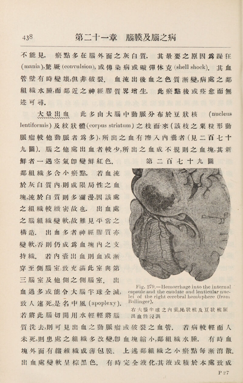 43§ 第二十一章腦膜及腦之病 不能見.瘀點多在腦外面之灰白質.其最要之原因爲躁狂 (mania)，驚厥(convulsion),或傳染病或礙彈休克(shell shock).其血 管壁有時變壤，伹非破裂.血流出後血之色質漸變，病處之鄰 組織水腫，而鄰近之神經膠質畧增生.此瘀點後或痊愈而無 迹可尋. 大景出血 此多由大腦中動脈分布於豆狀核 (nucleus Jentiformis)及紋狀體(corpus striatum)之枝而'來（該枝之粟粒形動 脈瘤較他動脈者爲多），所出之血有滲入內囊者（見二百七十 九圖）.腦之他處出血者較少，所出之血成不規則之血塊，其新 鮮者一遇空氣卽變鮮紅色. 第二百七十九圖 鄰組織多含小瘀點.若血流 於灰白質內，則成限局性之血 塊，流於白質則多瀰漫，因該處 之組織較緻密故也.出血處 之腦組織變軟，故難見平常之 構造.出向多者神經膠質亦 變軟，否則仍成爲血塊內之支 持織.若內囊出血則血或漸 穿至側腦室:致充滿此室與第 三腦室及他側之惻腦室.出 血過多或能令大腦半球全滅， 致人速死，是名中風(apoplexy). 若將此腦切開用水輕輕將腦 質洗去，則可見出血之動脈瘤或破裂之血管.若病較輕而人 未死，則患處之組織多改變，卽血塊縮小，鄰組織水腫.有時血 塊外面有纖維織成薄包膜.上述鄰組織之小瘀點每漸消散. 出血處變軟呈棕黑色.有時完全液化，其液或積於本處致成 Fig. 279.—Hemorrhage into the internal capsule and the caudate and lenticular nuc¬ lei of the right cerebral hemisphere (from Bollinger). 右大腦半球之內囊，尾状核及豆狀核顯 出血性沒潤