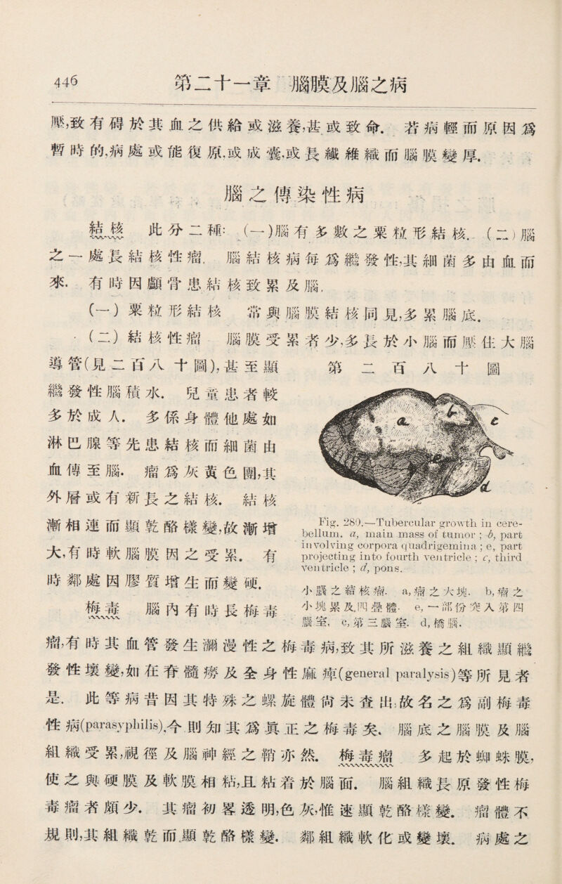 壓，致有碍於其血之供給或滋養，甚或致命.若病輕而原因爲 暫時的，病處或能復原，或成囊，或長纖維織而腦膜變厚. , ,腦之傳染性病 …、 … :• I ' • . ; » • - £ J • • • • - «< . . m此分二種：（一)腦有多數之粟粒形結核「（二）腦 之一處長結轉性瘤.腦結核病每爲繼發性，其細菌多由血而 來.有時因顱骨患結核致累及腦， (一）粟粒形結核常與腦膜結核同見，多累腦底. •(二）結核性瘤腦膜受累考少，多長於小腦而歷住大腦 導管（見二百八十圖），甚至顯 第二百八十圖 繼發性腦積水.兒童患者較 多於成人.多係身體他處如 淋巴腺等先患結核而細菌由 血傳至腦•瘤爲灰黃色團，其 外層或有新長之結核•結核 漸相連而顯乾酪樣變，故漸增 大，有時軟腦膜因之受 累. 有 projecting into fourth ventricle'; V, third ventricle ; d, pons. 時鄰處因膠膂增牛而糍砸 ^ ^曰土叩變观. 小膦之結核瘤.a，痫之大塊.b，瘤之 梅毒 腦內有時長梅毒 小塊累反TO疊體.e,—部份突入第四 c,第三腦室.d,橋腦. 瘤，有時其血管發生瀰漫性之梅毒病，致其所滋養之組織顯繼 發性壤變，如在脊髓廢及全身性麻庫(general paralysis)等所見者 是‘此等病昔因其特殊之螺旋體尙未查出;故名之爲副梅毒 性病(Parasyphilis)，今則知其爲眞正之梅毒矣t腦底之腦膜及腦 組織受累，視徑及腦神經之銷、亦然.梅毒痛多起於蜘蛛膜， 使之與硬膜及軟膜相粘，且粘着於腦面.腦組織長原發性梅 毒瘤者頗少•其瘤初畧透明，色灰，惟速顯乾酪樣變.瘤體不 規則，其組織乾而•顯乾酪樣變•鄰組織軟化或變壤.病處之