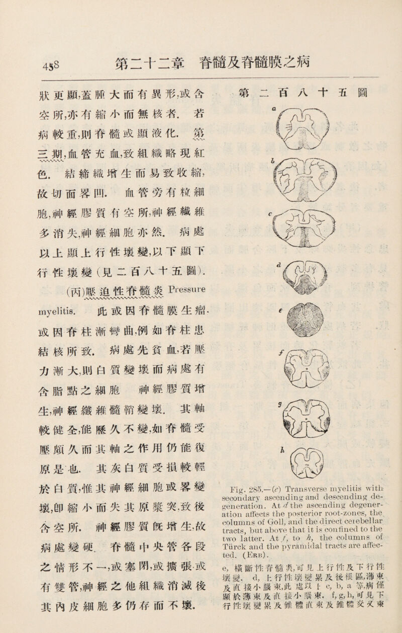 第二十二章脊髓及脊髓膜之病 狀更顯，蓋腫大而有異形，或含 空所，亦有縮小而無核者•若 病較重，則脊髓或顯液化•篑 三期，血管充血，致組織略現紅 色.結締織增生而易致收縮， 故切面畧凹•血管旁有粒細 胞，神經膠質有空所，神經纖維 多消失，神經細胞亦然•病處 以上顯上行性壤變，以下顯下 行性壤變（見二百八十五圖）- (丙)壓迫性脊髓炎Pressure myelitis. 此或因脊髓膜生瘤* 或因脊柱漸彎曲，例如脊柱患 結核所致.病處先貧血，若壓 力漸大，則白質變壤而病處有 含脂點之細胞神經膠質增 生，神經纖雜髓鞘變壤.其軸 較健全，能歷久不變，如脊髓受 壓頗久而其軸之作用仍能復 原是也.其灰白質受損較輕 於白質,惟其神經細胞或畧變 壤，卽縮小而失其原漿突，致後 含空所.神經膠質旣增生，故 病處變硬.脊髓中央管各段 之情形不一，或塞閉，或擴張，或 有雙管，神經之他組織消滅後 其內皮細胞多仍存而不壤• 第二百八十五圖 Fig. 285.— (<?) Transverse myelitis with secondary ascending and descending de¬ generation .A.t> d the ascending degener¬ ation affects the posterior root-zones, the columns of Goll, and the direct ceiebellar tracts, but above that it is con lined to the two latter. At/, to h, the columns of Tarek and the pyramidal tracts are affec¬ ted. (Erb). e，橫斷性脊髓乳可見上行性及下行性 壤變.<1，上行性壊變累及後根區，薄亨 及直接小腦束，此處以.卜c, b，ft .病病僅 顯於薄束及直接小職束.f，g，乜，时見下 行性壤變粜及錐體直裝及錐體交夂束