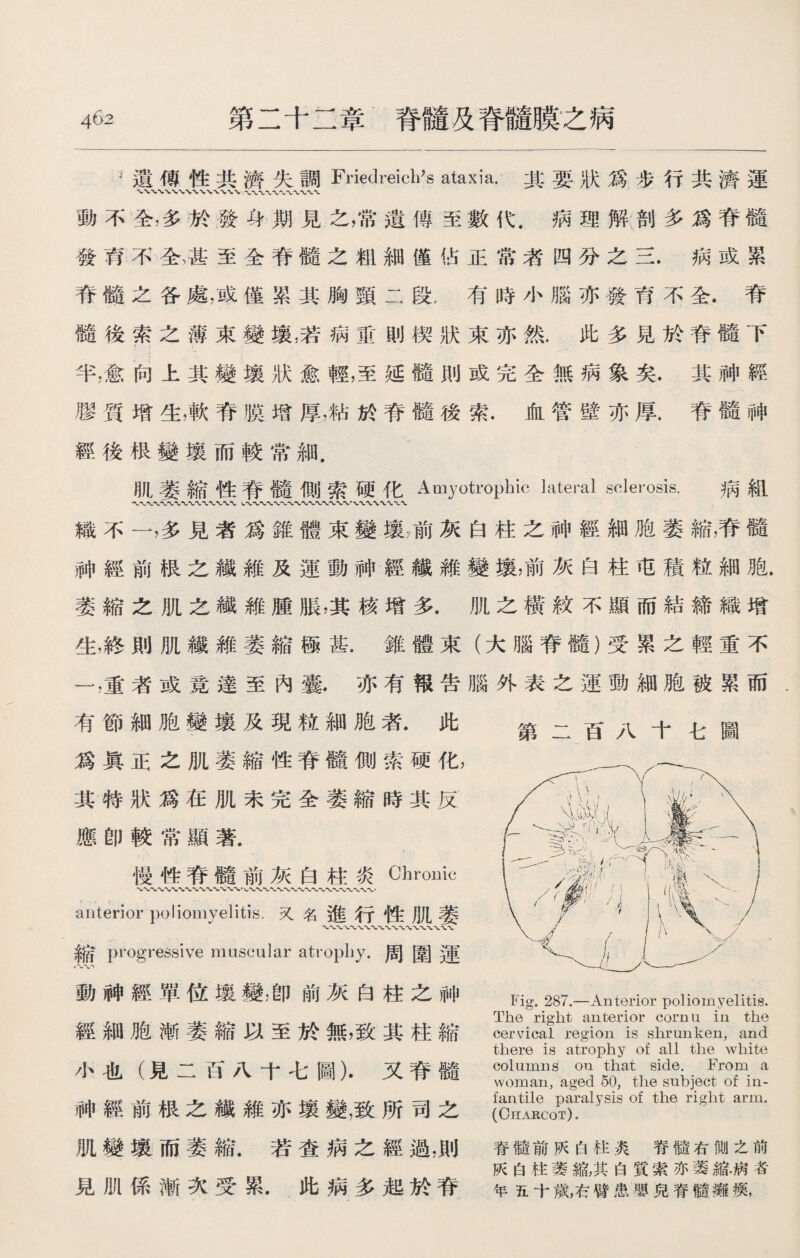 3遺傅性共濟失調Friedreich’s ataxia•其要狀爲歩行共濟運 動不全，多於發身期見之，常遺傳至數代.病理解剖多爲脊髓 發育不全，甚至全脊髓之龃細僅佔正常者四分之三.病或累 脊髓之谷處，或僅累其胸頸二段：有時小腦亦發育不全.脊 髓後索之薄束變壤，若病ffi則楔狀束亦然.此多見於脊髓下 半，愈向上其變壤狀愈輕，至延髓則或完全無病象矣.其神經 膠質增生，軟脊膜增厚，粘於脊髓後索.血管壁亦厚.脊髓神 經後根變壤而較常細. 肌萎縮性脊髓側索硬化Amyotrophic lateral sclerosis. 病組 〜〜〜〜〜Vw*VV〜〜〜〜*〜〜〜 織不一，多見者爲錐體束變壤屬灰白柱之神經細胞萎縮，脊髓 神經前恨之纖維及運動神經纖維變壤，前灰白柱屯積粒細胞. 萎縮之肌之纖維腫脹，其核增多.肌之橫紋不顯而結締織增 生，終則肌纖維萎縮極甚.錐體東（大腦脊髓）受累之輕重不 一，重者或竟達至內囊.亦有報吿腦外表之運動細胞被累而 有節細胞變壤及現粒細胞者.此 爲眞正之肌萎縮性脊髓側索硬化， 其特狀爲在肌未完全萎縮時其反 應卽較常顯著. 慢性脊髓前灰白柱炎Chronic V〜*V WV〜*v-〜〜*wwv* anterior poliomyelitis.叉名進行性肌萎 縮 progressive muscular atrophy.周圍運 動神經單位壤變，卽前灰白柱之神 經細胞漸萎縮以至於無，致其柱縮 小也（見二百八十七圖）.又脊髓 神經前根之繊維亦壤變，致所司之 肌變壤而萎縮.若查病之經過，則 見M係漸次受累.此病多起於脊 第二百八十七圖 Fig. 287.—Anterior poliomyelitis. The right anterior corn a in the cervical region is shrunken, and there is atrophy of all the white columns on that side. From a woman, aged 50, the subject of in¬ fantile paralysis of the right arm. (Charcot). 脊髓前灰白柱炎脊髓右側之前 灰白柱萎縮，其白質索亦萎縮.病者 年五十歲，右臂患■兒脊髓癱瘐，