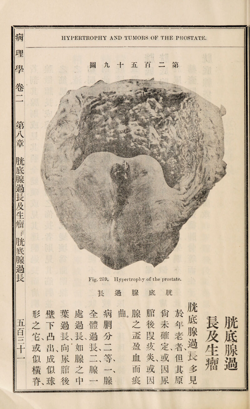 病 HYPERTROPHY AND TUMORS OF THE PKOSTATE. .-w-去 .r.巧 第 巧 五 九 圖‘ y I I tb 脱 底 腺 過 眞 脫底腺過 長及生瓣 脫底腺過、長多見 於年老豪化其原 尙未確{H^或因尿 脂後段疚炎、或因 腺之壺盈血而痕 0 曲 病網分一 腺 全體過裝二腺一 處過？如腺之中 葉過私邮尿腊後 壁下凸化、成似球 杉之也或似橫家 哪一學卷rl. 第八章賊底腺過長义生槪脫底腺過提 五酉三千‘