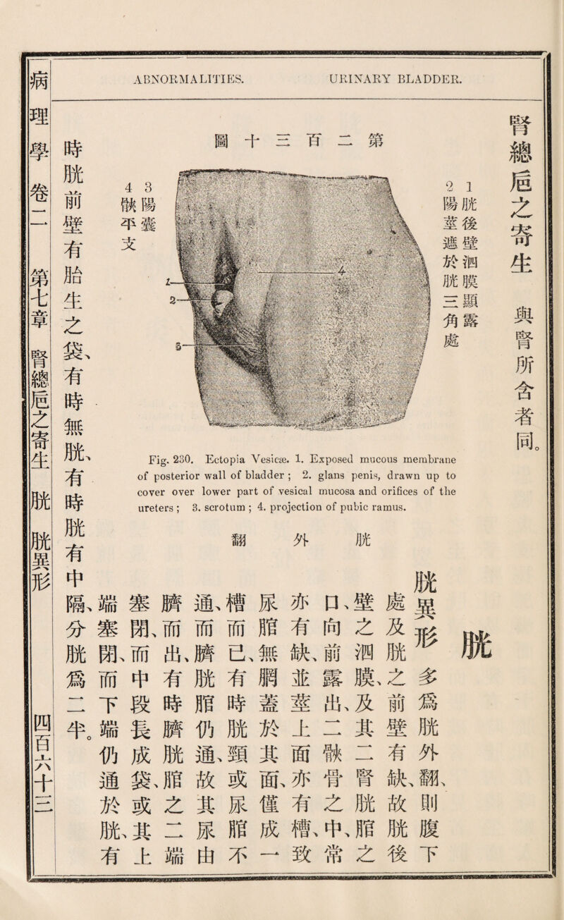 Fig. 230. Ectopia Vesicse. 1. Exposed mucous membrane of posterior wall of bladder ; 2. glans penis, drawn up to cover over lower part of vesical mucosa and orifices of the ureters ; 3. scrotum ; 4. projection of pubic ramus. 潮 外 銃 時 脫 -一 * 即J 壁 有 胎 生 之 袋、 有 時 無 賊、 有 時 脱 有 中 隔、 分 脫 爲 一 • 5。 ABNORMALITIES. URINARY BLADDER 1脱後壁涧膜顯露 2陽莖遮於脱s角處 3陽囊 4献平支 脫異形多爲脱外狐、則腹下 處及麻之前壁有献故脱後 壁之测膨及其二腎脱腊之 ri向前露私二狱骨之扣常 亦有紙並莖上面亦有歡致 尿贈無網蓋於其配樓成一 槽而已有時脫頸或尿脂不 氣而麟脱脂仇氣故其尿曲 麟而耻有脖麟脱脂之二端 塞亂而中段長成豁或^上 端塞亂而下端仍通於版有 腎總盾之寄生輿腎所含者同。 拥|理學卷二 第*章腎總盾之寄生脱脫異形 四百六十一二