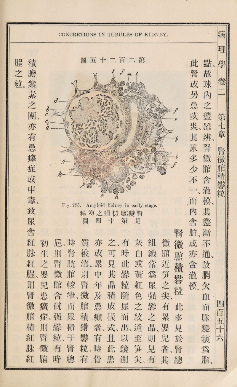 CONCRETIONS IN TUBULES OF KIDNEY. 病 3b rHl一 一一 c—f fhx.」，3rr 1^、•二 ■ Ml—! ■‘ ^ ,0 :——I ,-1- M 理學卷 第A章.腎微脂稽 點故球內之鑑雛辨腎 此腎或另患疚氮某尿多少不f而內含 第 巧 二 十 五 圖 _四百五4^_ 贈含澈觀具懲漸不通、故網欠血而滕變壞爲脂、 腊、或亦含澈觀 腎微胞積變粒此多見於腎總 腎 見 微脂近籌之尖有累嬰 組織常爲尿强攀之晶、則見有 灰白或黃紅色之紋通至異八丸 有、時此變紐隨尿而攻鏡測 之、可見其晶積成横充且此患 亦或累中年及患痛有時骨 質被消則腎微腊積鑛變亂有 時腎脫贈較智而尿穗于腎總 齡則腎微脂含就强變亂有時 、 、 初生之嬰兒患廣忠則腎微膽 積膽紫素么亂亦有患籍症或中I斯致尿含紅獻紅則腎微贈穗紅滕紅 腥之秘 敷第 臟十 之四 初1 程圖