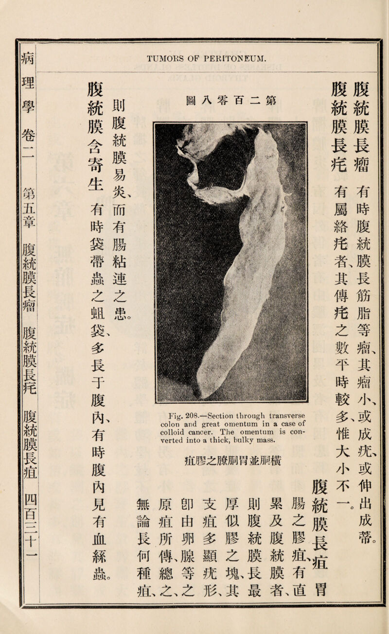 Fig. 208.—Section through transverse colon and great omentum in a case of colloid cancer. The omentum is con¬ verted into a thick, bulky mass. 谊膠之騰顺胃並顺橫 TUMORS OF PERITONEUM. 腊之膠痘有道 累及腹統膜扳 則腹統膜長最 厚似膠之狐其 支痘多顯沈/私 卽由卵腺等之 原痘所觀總么 、 有時腹統膜長鋭脂等瘤、其癖小、或成紙或伸出成氣 有屬絡巧氣其傳淹之數平時較少惟大小不一。 腹統膜長痘胃 腹統膜長瘤 I腹統膜長疮 築 二 百 I 審 A 圖 無論長何種痘 則腹統膜易瓜而有腸綻連之宰I、 、 。 腹統膜含寄生有時袋帶蟲之姐换多長于腹味有時腹內見有血絲赢 —學卷TT11S氧i，瞧擁膜’^1:腹統麟霞拍腹統膜長痘四音S十一