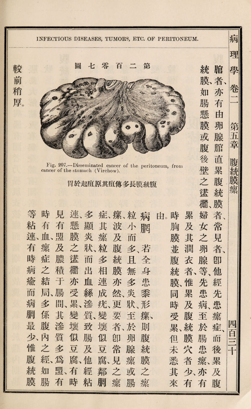 圖毛審百二第 Fig* 207.一Disseminated cancer of the peritoneum, cancer of the stomach (Virchow). 胃於起谊原其道傳多長膜絲膽 from 統膽 膜、者、 戈口亦 勝有 懸由 膜卵 或腺 腹脂 後直 壁累 之腹 蠻統 颗胃、膜 時累婦者、 胸及女常 膜其之見 並潤卵者、 腹衣腺卽 統者、等、他 膜、惟先經 同累患先 時及病、患 受腹至攘 累、統於症、 化膜腊耐 未穴患後 悉者攘、累 其少、亦及 來有有腹 INFECTIOUS DISEASES, TUMORS, ETC. OF PERITONEUM. o 曲 病網若、全身患黎形觀則腹統膜之攘 ^小而多、且無多炎狀至於卵腺攘或腸 氣波及腹統膜亦紙更要私卽常見之攘 抵其攘^多相連成张變壞似豆獻鄰網 參一顯炎狀、而出血絲滲鼠致腸及他經粘 連、懸膜之蠻繼亦受寧W變壞似豆腐有時 見有盛及濃積于腸亂其滲質多爲亂有 時有也攘症之結鼠多係腹內之鑑如腸 等粘數有時病癒而病網最少惟腹統膜 ■Hm 較前稍厚 病理學卷 第五章腹統曠攘 四百一二十