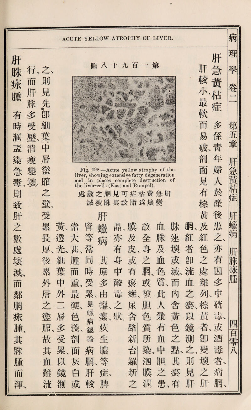 t acute yellow atrophy of ltvek. 肝急黃嚇症多係靑年婦人於產 肝較心最軟而易脈剖面見有檢 第 百 九 十 A 圖 後患之亦有因多中就毒或酒毒者病網 黃及紅色之處雜讯糕、黃載卽壞之肝 狀紅者卽流血之獻3^鏡測之、則見肝 滕速壞或孤而內含黃包之献其齋 血滕及血色鼠此人兼有血中胆之弔 ^ 故全身之綱、或被胆色質所載测膜潤 膜及皮或有淚瓣尿含路新台羅新之 日i亦有身带酸毒之狀 、 臟病其原多由癒獻疚生濃等私脾 腎等常同時受累見《病總論病職巧較 谭大也腫而塞最祗色數剖面灰白或 氣透兔綱葉中.外二曆多受累、鏡測 K一則見先。卽細葉—中層盤脂之壁、受累長原後累外層之懲齡故其血難流 朽而肝滕多受壓消瘦變攘 、 巧脉巧歷有時醒盡染急秦則致肝之數處壞孤而鄰網據肢其滕腫而氣 1 S 病理學卷二 第五章肝急黃枯症肝蜡病肝滕炼腫 四百零八