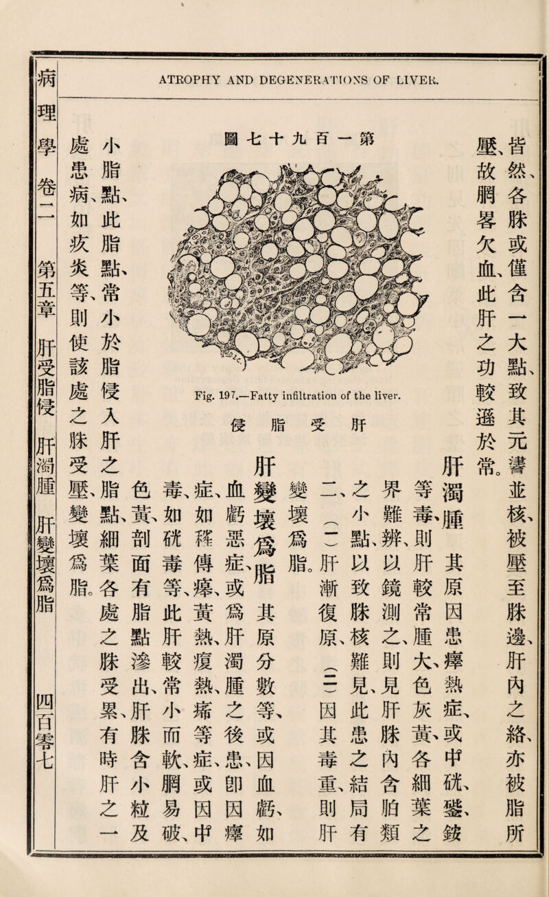 皆新各滕或健含一大獻致其元譬並檢被壓至滕載肝巧么觀亦被脂所 鉱故網葛欠血、此肝之巧較遜於驚 肝濁嘯其原因患^熱扳或中旅恶銭 等蕾^肝較常腫丸色灰赏各細葉之 界難欺鏡測之、則見肝滕內含胎類 之小祇、致滕核難見此患之結局有 一一 (1)肝漸復欣(二)因其毒氣則肝 變壞爲脂。 肝變壞爲^其原分數黨或因血獻如 血戲惡私或爲肝濁腫之後串卽因摩 私如釋傳豁黃說瘍飯矯等私或因中 戴如就毒歡此肝較常小而齡網易脈 色赏剖面有脂點滲狀肝滕含小粒及 小脂献此脂献常小於脂侵人巧之脂紙細葉各處之滕受®4有時肝之一 處愚病如疚炎集則使該處之滕受嚴變壞爲臘 病理學卷1 1 第五章肝受脂侵肝濁腫肝變壞爲脂 四百蕃韦