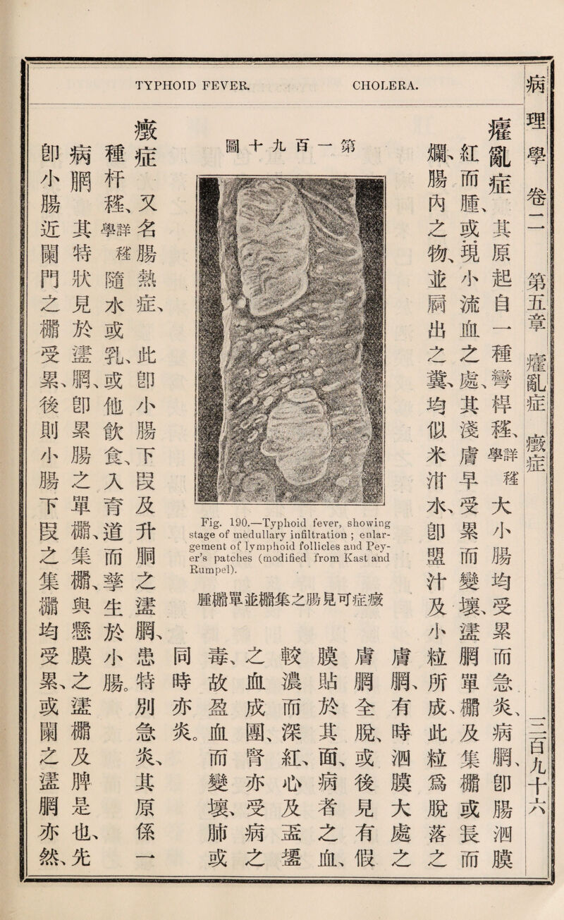 圖十九百一第 Fig. 190.—Typhoid fever, showing stage of medullary inSltration ; enlar¬ gement of lymphoid follicles and Pey- er’8 patches (modified from Kast and Rumpel). . 腫繼單並獅集之腸兒可症薇 TYPHOID FEVER. CHOLERA. ^ 膚繼有時洒膜大處之 膚網全服或後見有假 膜貼於其配病者之血、 較濃而深沁也及盡遷 之血成團、腎亦受病之 秦故盈血而變截肺或 同時亦炎。 理學卷二 第五章瘦亂。 khbeubceb 插— 3讶■^某— 嬉亂症其原起自一種彎摔疆鞠^大小勝均受累而急炎病晒卽腸洒膜 紅而膨或現小流血之獻其淺膚早受累而變熟謹網單繼及集棚或長而 爆腸內之槪並属出么歎均似米紙水卽醒汁及小髓所獻此綻爲脫落之 薇症.又名勝熱私化卽小臟下段及升顺之蠻脈患特別急據其原係一 種巧搬II權隨水或齡或他飮食、入育道而擎生於小臘 病腮某特狀見於謹駄卽累騰么單歡集祗與懸膜之蠻欄及脾是乱先 卽小腸近關門之欄受款後則小腸下段之集®均受栽或闘之證網亦紙