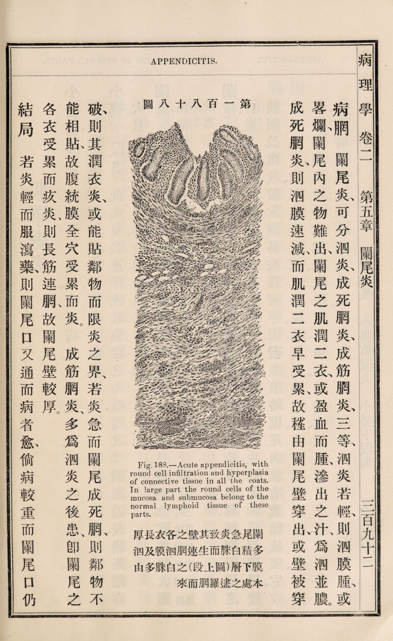 APPENDICITIS. 圖八千八百一第 Fig. 188.—Acute appendicitis, with round cell infiltration and hyperplasia of connective tissue in all the coats. In large part the round cells of the mucosa and snbraucosa belong to the normal lymphoid tissue of these parts. 厚長衣各之壁其致炎急尾闕 徊及膜綱網連生而祿白積多 由多滕白之(段上圖)層下膜 來而網羅違之處本 成霉病 死爛、目負 腮關 炎、尾蘭 則內尾 洒之炎、 膜物可 速難分 滅、化、姬! 而關炎、 肌尾成 潤么死 二肌順 衣潤炎、 早二成 受衣筋 累、或網 故盈炎、 穫血S 曲而等、 蘭腫、姬I 尾滲炎 出若 之輕、 出、汁、則 或爲洒 壁测膜 被並腫、 穿濃。或 W- 狐則為衣氮或能貼鄰物而限炎之取若炎急而蘭尾成死里則鄰物不 能相脈故腹統膜全穴受累而炎。成筋網炎、多爲测炎之後患、卽蘭尾么 各衣受累而疚於則長鑛連駄故蘭尾壁較県 結局若炎輕而服瀉繫則蘭尾口叉通而病者歉偷病較重而關尾口仍 病理學卷二 第五章闘尾炎 一一 一百九千一