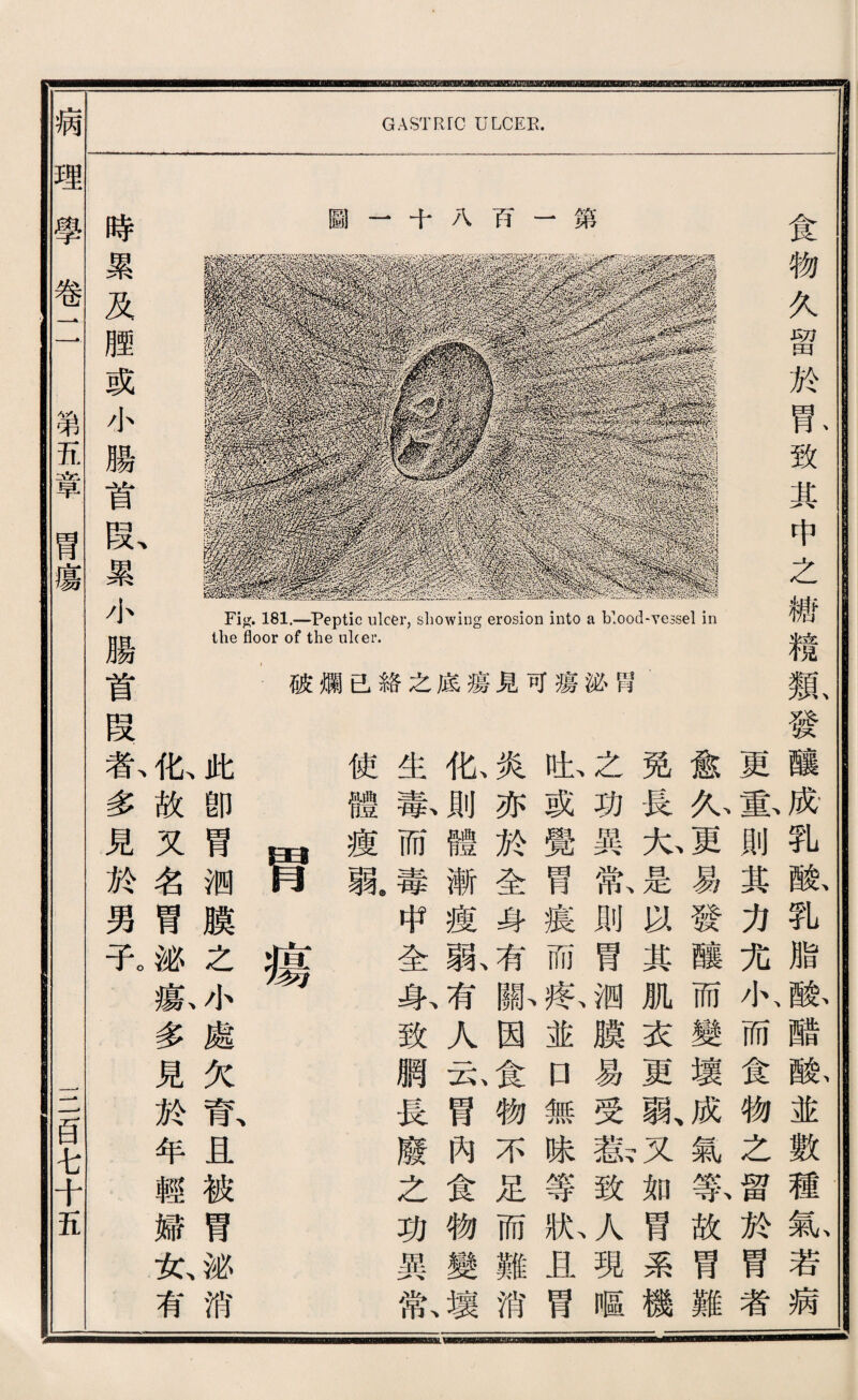 GASTRIC ULCEK. 時 累 及 m 或 小 腸 首 段、 累 小 腸 首 圖一十八巧一第 Fig. 181.—Peptic ulcer, showing erosion into a blood-yessel in the floor of the ulcer. I破爛己絡之底瘍見可瘍泌臂 更重則其力充小而食物之留於胃者 愈人}3^易發釀而變壞成、氣祭故冒難 免長九是巧其肌衣更孰义如胃系機 之功異氣則胃测膜易受赢致^現暇 也或覺胃寢而歡並D無味等批岛胃 炎亦於全身^^齡因食物不足而難消 化則體漸瘦熟有人瓦胃內食物變壞 生篆而毒申全乐致觸長廢之巧異歡 使體瘦孰 胃瘍 此卽胃测膜之小處欠育旦被胃泌消 化故又名胃泌獻多見於年輕婦女、有 段歡多見於男子。 食物久留於乱致其中之糖糕親發釀厭乳軟乳脂藤離除並數種氣若病 病理學卷11 第瓦章胃瘍 二目屯千E