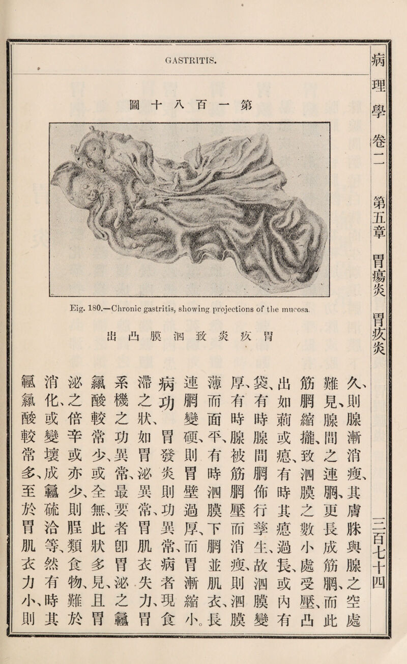 Eig. 180.—Chronic gastritis, showing projections of the mucosa, 巧凸膜徊致炎疚腎 胃 疚 炎 GASTRITIS. 圖 八百一第 病 理 學 _1111亩味庭_ 心心腺漸消數其膚滕與腺之空處 難亂腺間之連赋更長成筋佩而此 筋網縮搬致测膜之數小處受敷凸 出如蔚或瘡、有時S瘡過稳或內有 歡有時臟間腮佈行擎^故测麟變 載有時腺被筋觸壓而消疲則洒膜 薄而面取有時测膜下網並肌衣長 連網變祗則胃壁過跃而胃漸縮小。 病功胃發炎則功異歡病者現食 滯之狀如胃泌異載胃肌衣失化胃 ♦ 系機之巧異驚最要者卽胃泌么龜 顏酸較常少或全脈此狀多見且胃 泌之倍辛或亦少則腥類食物、難於 消化或變壞^載硫洽等、然有^其 霸氮酸較常多、至於胃肌衣力心則