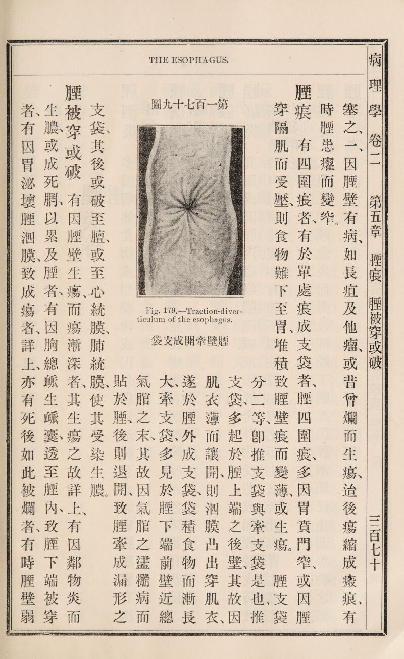 圖九十毛百一第 Fig. 179.—Traction-diver¬ ticulum of the esophagus. 袋支成開牽壁@ 支 袋、 置 後 或 破 至 膽、 或 至 統 膜、 肺 統 膜、貼 使於 丑: i 染 生 濃C 煙、 後 則 退 開、 致 腥 牽 成 漏 形 之 支袋多超於贈上端之後壁其故因 肌衣薄而讓亂則綱膜西出穿肌衣 遂於歴外成支豁袋積食物而漸長 丸牽支豁多見於鹏下端前壁近總 氣服之表其故因氣脂之謹纖病而 腰被穿或破有因輕壁生瘍而瘍漸深氣其生瘍之故詳上、有因鄰物炎而 .生膨或成死臘巧累及禮春有因胸總賴生峨藝透至顧扣致贈下端被穿 春有因胃泌壞赠徊瞭致成瘍氣詳山亦有死後如此被爛东有時腥壁弱 f SE-tBunnll一 111-1111=1 llll ITIn—nTlBWBrnlnlalnBIWmc—In 理學卷二 第君章煙寢艘破穿或破 I, S百屯千 塞之、一、因顧壁有病、如長痘及他囑、或昔曾爛而生款遙後瘍縮成疵款有 時輕患遷而變卷 腰瘍有四圍寢眷有於單處寢成支袋款經四圍藤多因胃實門暫或因歷 穿隔肌而受歌則食物難下至乱堆積致體壁痕而變澈或生驗腥支袋 分二幕卽推支袋輿牽支袋是化推