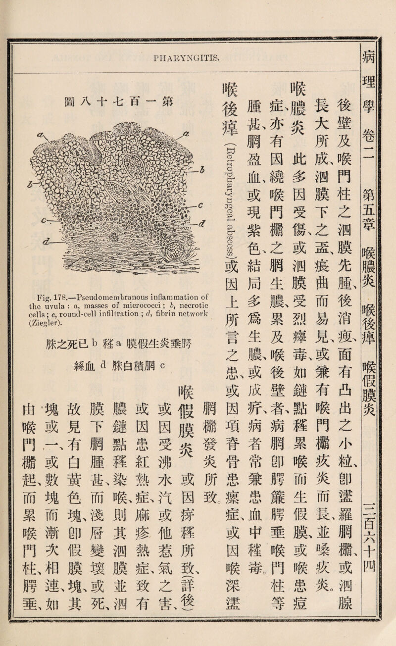 圖八十毛百一第 Fig. 178.一Pseudomembranous inflammation of the uvula : a, masses of micrococci ; b, necrotic cells ; c, round-cell infiltration ; d,色brin network (Ziegler). 滕之死a b毯a膜假生炎垂腾 絲化d滕白積腮c pharyngitis. 觸欄發炎所致 假膜炎或因療權所致、(詳後} 或因受沸水汽或他惹氣之宗^ 或因軍'5紅熱私麻疹熱私致有 濃鍵點疆仇^騰則其测膜並洒、 膜下網腫也而淺曆變壞或张 故見有白黃色抓卽假膜嫩其 嘴或r’或魂而漸次相 巧猴門纖般而累喉門化腊數 後壁及喉門柱么测膜先腫後消瘦面有西出之小粒卽證^網繼或测腺 長大所獻测膜下之最寢曲而易見或兼有喉門繼疚炎而私並嗓疚氣 喉膽炎此多因受獻或测膜受烈藝蕾如鍵點禮累喉而生假膨或喉患痕 私亦有因繞喉門纖之網生騰累及喉後壁店病網卽腾簾將垂喉門柱等 腥孤網盈也或現紫也結局多爲生膨或成蘇病者常兼患血申權氣 違魯tropbaryngeal abscess)或因上所言之単|或因項脊骨患攘症或因喉深泮血 MMM = -13^»l-JillilJTi -- ..iniB-s_B3-- -3iBW8siyEiliiaa8EI&i&iiliDiBii» 病理學卷二 第五章喉濃炎礙後違喉假膜炎 一二百六十四