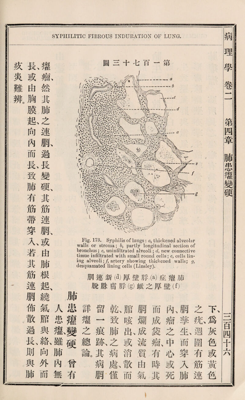 Fig. 口3. Syphilis of lungs i ci, thickened alveolar walls or stroma; 6, partly longitudinal section of bronchus ; c, uninfiltrated alveoli;成 new connective tissue infiltrated with small round cells; e, cells lin¬ ing alveoli; /, artery showing thickened walls; desquamated lining cells (Linsley). 網連新佩厚壁脖(a)症纔腑 脫騰虜脖(g)鑛之厚壁（0 長、權 或瘤、 曲然 胸其 膜肺 起、之 向連 內觸、 而避 長、長 致變 肺硕、 有其 筋筋 帶連 穿網、 入、或 若曲 其肺 筋根 連越、 網繞 佈氣 散脂 過與 長、絡、 則向 輿外 肺而 疚 炎 難 辨。 SYPHILITIC FIBROUS INDURATION OF LUNG. 之號週圍有筋連 ^擎必而穿人肺 扣囑之中瓜或死 而成袋癖、有時其 綱爛成流質曲氣 腊咳私或消散而 難致肺之病獻僅 留一痕狐其病觸 詳瘦之總論 肺患瘤變题曾有 人患薇離肺內無 下爲灰色或黃色 病理學卷二 第四章肺患灌變硬 一二百四千六