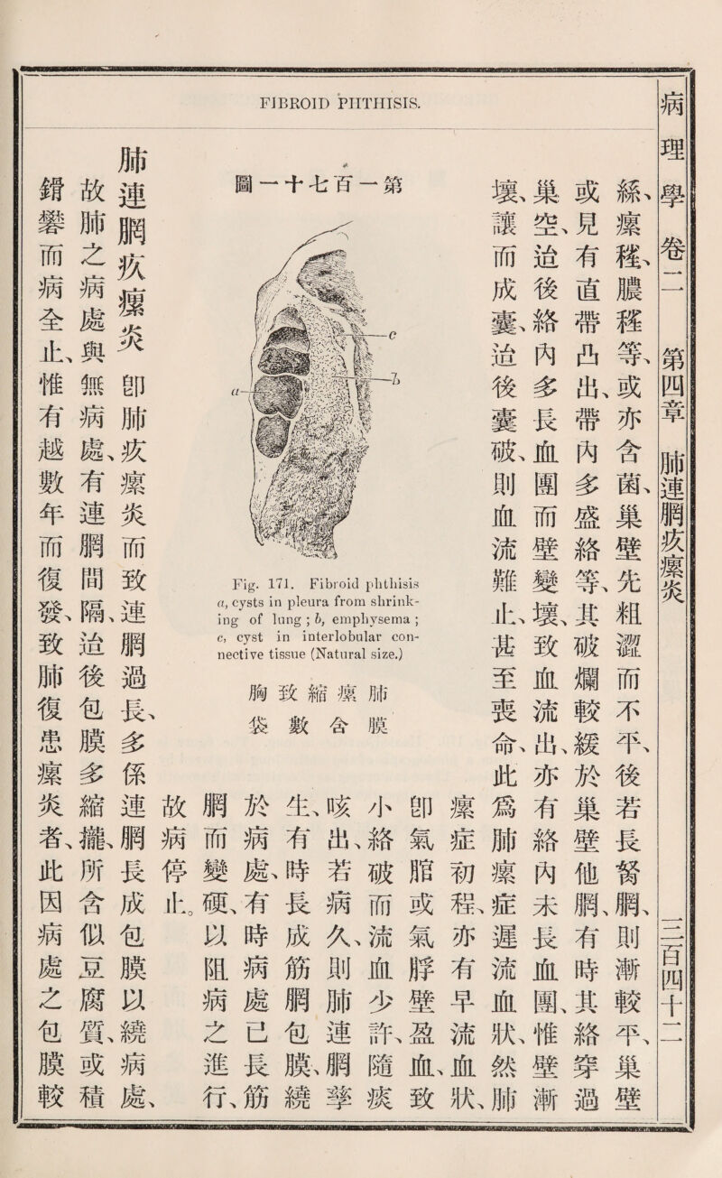 FJBROID PHTHISIS. 圖一十毛H—第 Fig. 171. Fibroid plitliisis a, cysts in pleura from shrink¬ ing of lun呂； 6, emphysema ; c, cyst in interlobular con¬ nective tissue (Natural size.) 胸致縮據肺 裳數合膜 攘症初程亦有早流^狀 卽氣脂或氣脖壁盈也致 小絡破而流血少記隨據 啄5^若瞒心則肺連網擎 必有時長成筋網包膨繞 於病胳有時病處已長筋 綱而變胁瞄病之進化 綠攘渡濃權暮或亦含齡巢壁先粗澈而不取後若長務既則漸較取巢壁 或有盧帶曲狀帶內多盛絡黨其破爛較緩於巢壁他駄有時其絡穿過 巢歡溢後絡內多長血觀而壁變數致血流壯亦有絡內未畏血亂惟壁漸 截讓而成囊遙後囊孤則血流難心甚至喪俞此爲肺攘症遲流血獻然腑 故病停北 肺連鹏疚據炎卽肺疚爆炎而致連網過良多係連網長成包膜喊繞病獻 故肺之病處與無病獻有連腦間齡遙後包膜多縮搬所含似基腐齡或積 銳變而病全止、惟有越數年而復歡致肺復患攘炎者、此因病處之包膜較 病理i學—^Tl^第四章肺連網疚攘炎I !. S百凹十二