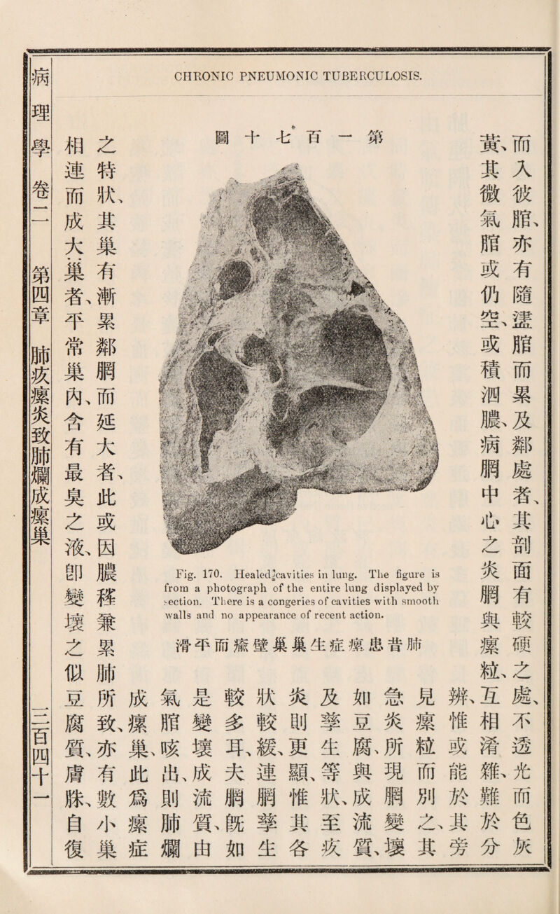 圖十毛百一第 Fig. 170. Healed^cavities in lung. The figure is from a photograph of the entire lung displayed by section. There is a congeries of cavities with smooth walls and no appearance of recent action. 滞平而赢壁巢巢生症據患昔肺 CHRONIC PNEUMONIC TUBERCULOSIS. 見攘紐而別之其 急炎所現網變 如豆獻與成流貧 及擎生等狀至疚 炎則更顯惟其各 狀較獻連網擎生 較多呆夫網旣如 是變壞成流睐、由 氣贈咳壯則肺爛 成攘^此爲攘症 之特狀其巢有漸累鄰網而延大者此或因臟權兼累肺所致亦有數小巢 相連而成大藥私平常巢亂含有最梟之撤卽變壞之似豆腐睐膚獻自復 而入彼脱亦有隨證脂而累及鄰處者其剖面有較硬之藤不透化而色灰 款其微氣贈或仍酱或積洒臟病網中也之炎綱與攘獻互相潜狐難於分 账惟或能於其旁 病理學卷 第四章肺疚攘炎致肺爛成攘巢 一二百四千 nB