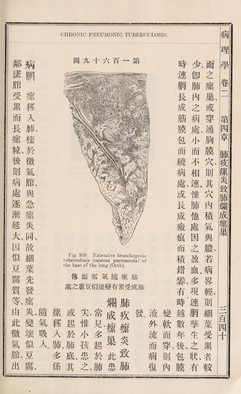 圖九十六百一第 Fig. 169. Extensive bronchogenic tuberculosis (caseous pneumonia) of the base of the lung (Orth). 傳丽脫氣隨攘腑 處之腐盈似壤變有累受底肺 CHRONTC PNEUMONIC TUBERCULOSIS. nHSBDOanBBBBBI irmninmififwiiiiniii i ii ii 液外流而病復 驚 脯疚據炎致脯 爛成療巢此患 常見多起於肺 务惟小孩患之 或起於肺底其 攘禮入版多係 、 隨氣吸乂 病網繁權入肌棲於微氣版與急攘炎亂故細葉先發攘私變壞似直既 I 鄰蠻脂受累而長攘亂後則病處逐漸延大、因似盈願質萬曲此微氣齡出 fs之攘載或穿通胸膜沁則其巧內積氣輿腺若病馨輸則細葉受累者較 少卽腑內之病獻小而不相數惟肺他處因之盈血、多現連網擎生之於有 時連網長成筋膜包而繞病朦或長成薇痕而積銳繫有時越數年歡包膜 變軟而策則巧 病理學卷 第四章肺疚攘炎致腑爛成褒巢 一二百四十