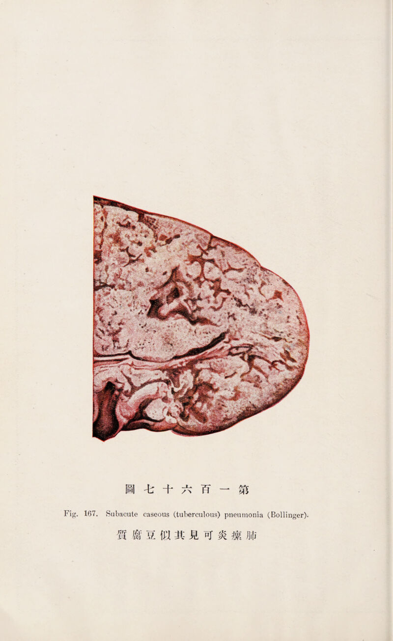 圓毛十六巧一築 167. Subacute caseous (tuberculous) pneumonia (Bollinger). 質腐豆似其見可炎攘肺