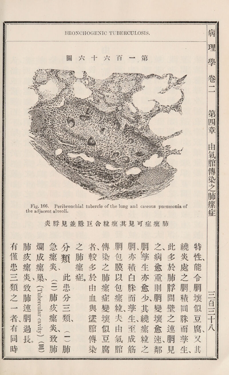 BRONCHOGENIC TUBERCULOSIS. 圃六十六百一第 Fig. 166. Peribronchial tubercle of the lung and caseous pneumonia of tlie adjacent alveoli. 炎脖見並祿甚含粧攘其見可症據脯 特祗能令網壞似基膨又其 繞炎處之腮積國賺而擎私 此多於肺脖間壁么連網見 ，乙病愈重則觸變壞愈載鄰 觸i学生亦愈少其繞攘粒么 脈亦積白賺而擎必至成鑛 網包膜试包攘亂夫曲氣赔 傅染之肺攘症變壞似置腐 春較多於曲血與蠻腊傳染 么肺攘拡 分類此患分S觀(三肺 急據衣三)肺疚攘影致肺 爛成攘巢《Tubercular cavity)(吉一) 肺疚攘私致肺連網過廣 有健患一二類之一氣有同時 病理學卷 第四章由氣脂傳染之肺攘症 S旨一二千八