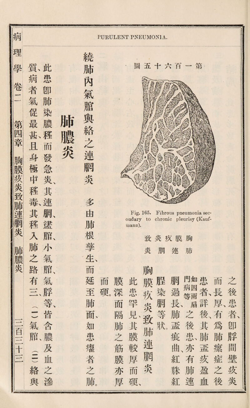 圆五十六巧一第 Fig. 165. Fibrous pneumonia sec¬ ondary to chronic pleurisy (Kauf- mann). 致炎疚膜胸 炎爛連肺 PURULENT PNEUMONIA. 之後患者卽脖間壁巧炎 而長載有爲肺攘症之後 患春詳歡其肺壺疚盈血 酬細獅扇之後款亦、有肺連 網過藤腑盡寢曲、紅滕紅 脂染網等狀 胸膜疚炎致脯連網炎 此患罕見其膜較厚而配 膜深面隔肺之筋膜亦厚 而硬 繞肺內氣腊輿絡之連胸炎多由肺根擎生而延至肺配如患痛者之版 沛變火 I 此患卽肺染濃禮而發急炎、其連腺謹鼠小氣脂、氣脖裳皆含屋及血之滲 I 貧病者氣促最瓜且身極中權蕾其稽人肺之路有二一 (1)氣狀(-n絡輿 學卷.11 I 臟换載致肺連網如—: IT音二书一一一