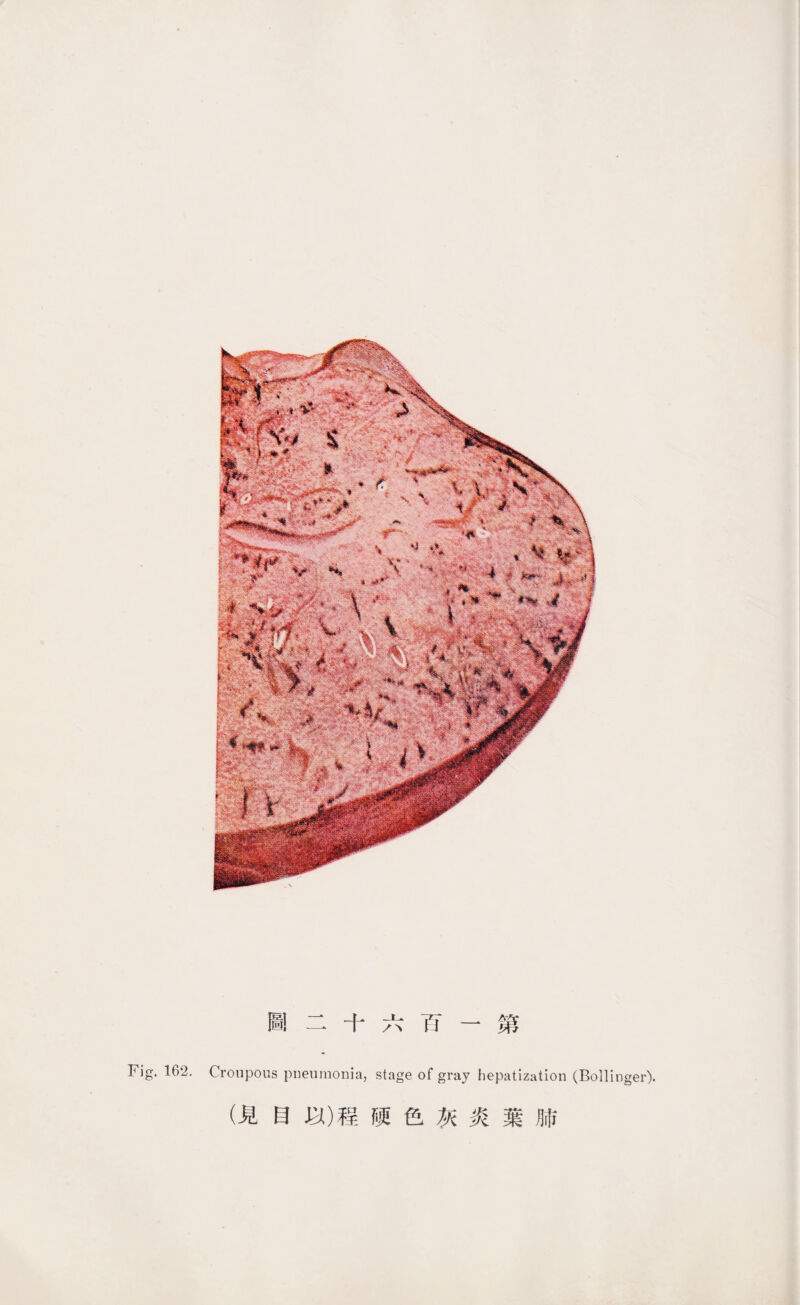 Fig. 162. Croupous pnenmonia, stage of gray hepatization (Bollinger). (見目•&)程硬色灰炎葉肺