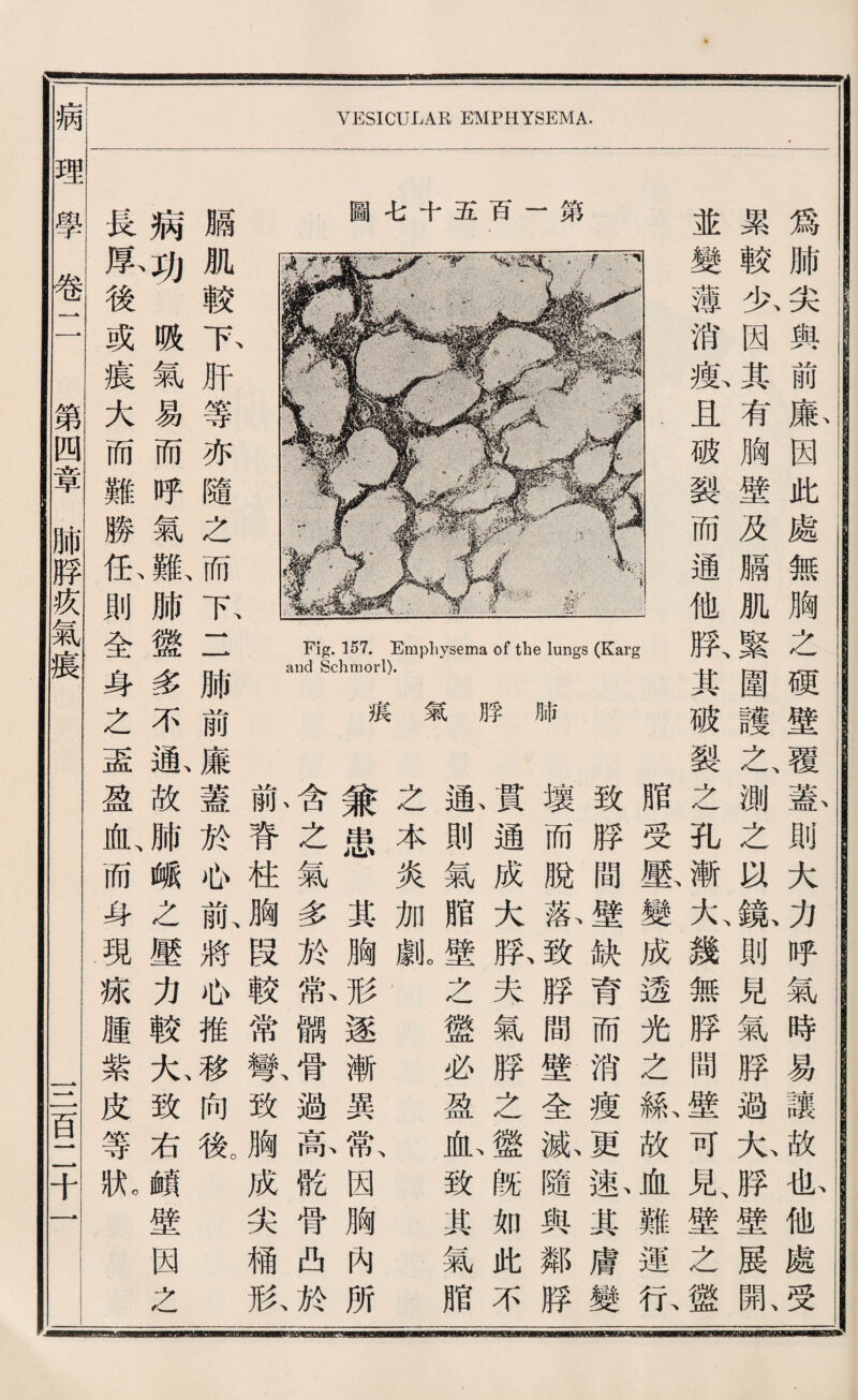 VESICULAR EMPHYSEMA. 爲肺尖與前廉画此 累較化因其有胸壁 並變薄消數且破•裂 第 一 百 五 十 毛 圖 瓜 S 打 U 臟肌較下肝等亦隨 病呵.贩氣易而呼 長原後或寢大而難 處無胸之硬壁覆蓋則大力呼氣時易 及臟肌緊圍護玄測之'W鑽則見氣脖 而通他院其破裂之化漸大、幾無脖間 脂受酿變成透光之 致脖間壁缺育而消 壞而脫歡致脖間壁 貫通成大騰夫氣脖 漸則氣腊壁之盤必 之本炎加就， 兼患其胸形遂漸 含之氣多於歡觸骨 脊枉胸段較常银 之而二肺前廉蓋於也亂將也推移 氣羞肺鑛多不氣故肺峨之壓力較九 勝佑則全身之孟盈乳而身現據歷紫 4& 巧 孚 巧 氣 摸 1 h • C gs — 1 F d 讓故也他處受 過九脖壁展亂 壁可見壁之盤 槪故血難運化 瘦更取一其膚變 全狐瞻與鄰脖 之盤旣如此不 盈也致其氣脂 異歡因胸內所 過琼骼骨曲於 致胸成尖稀狀 向餘 致右«壁因之 皮等狀 病理學卷一 第四章肺脖疚氣寢 一一盲二千一