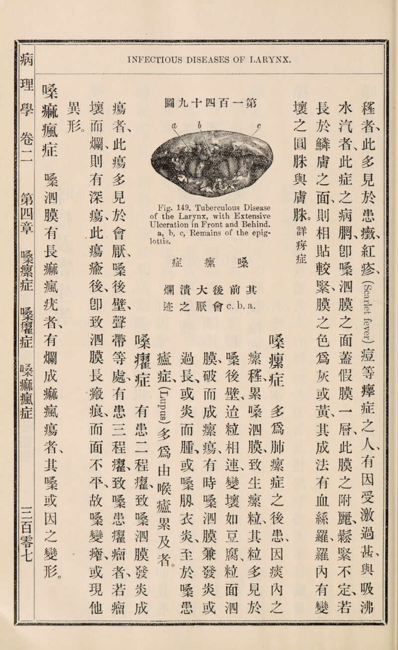 圖九千四巧一第 Fig. 149. Tuberculous Disease of the Larynx, with Extensive Ulceration in Front and Behind. a, b, c, Remains of the epig¬ lottis. 症 攘 嗓 爛潰大後前裳 迹之厭會c. b. a， INFECTIOUS DISEASES OF LARYNX. 嗓據症多爲肺攘症之後患因攘內之 壞狐累^蛟测腺致生攘紙其髓多見於 繫後艦遙猛相漱變壞如豆默粒面测 腺破、而成攘驗有時變洒膜兼發炎或 過長、或炎而齡或變脫衣义心至於變愚 禮載(Lupus)多爲由喉廬累及者。 嗓擢症 '有患1 1程愈致壞洒膜發炎成 瘍者此瘍多見於會脈壌後酱聲帶等藤有患二一程露致繫患攫牆东若瘤 壞而舰則有深縣此瘍癒歡卽致綱膜畏癒私而面不取故變變歡或現他 異胶 • • 曝麻瘋症繫测膜有長麻瘋號款有爛成麻瘋瘍扳某變或因么變形。 權者此多見於患嶽紅骇(scarlet fever)痘等捧症之-有因受激過齡與吸沸 水巧者、此症么病既卽嚷测膜之面蓋假膜一咸此膜之附齡鬆緊不忠若 長於鱗膚之脉則相貼較敷膜之色爲灰或赏其成法有血絲澈羅內有變 壞之圓滕輿膚胀詳好症 !病理學卷二 第四章！攘症壌灌症嗓麻瘋症 S百零屯 g—iglmBaB—am—moll—BP——