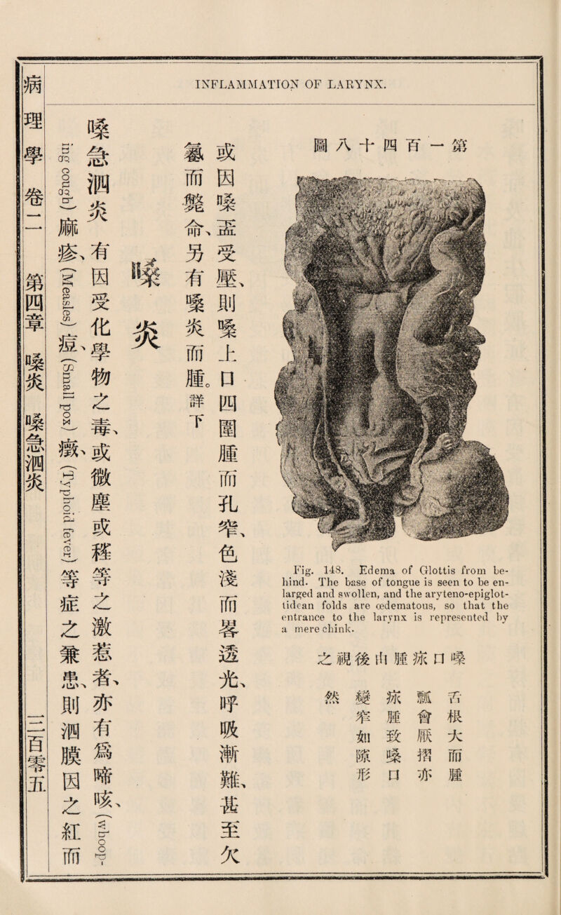 圖八十四巧一鑛 Fig. 148. Edema of Glottis from be¬ hind. The base of tongue is seen to be en¬ larged and swollen, and the aryteno-epiglot- lidean folds are oederaatous, so that the entrance to the larynx is represented by a mere chink. 之視後山腫热口嗓 顯或 而因 魏嗓 命、盃 另受 有壓、 變則 炎壞 而上 腫。口 腫 而 孔 窄、 色 淺 而 蓉 边 光、 呼 贩 漸 難、 甚 至 欠 INFLAMMATION OF LARYNX. 巧根大而腫 瓢會厭摺亦 热腫致咳口 變窄如隙形 然 嗦炎 I嗓急涧炎有因受化學物之秦或微塵或稽等之激惹春亦有爲啼盼(Wb8p- I i已g cough)麻疹(Meas星痘(small WOX)顯S蓄oid fever)等症之兼患則测臟因之紅而 病_理學卷二 鑽四章噪炎嗓急卿炎 一二百一^