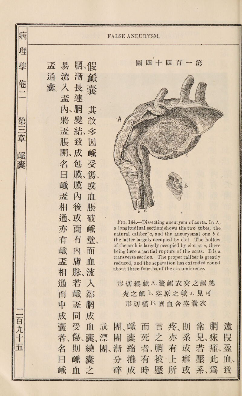 盡易觸 通流漸戯 囊。入長蠢 盡連 內、觸其 將變故 盡結、多 脹致因 開、成峨 名包受 日膜、傷、 峨膜或 盡內血 相後脹 通、或破• 亦面峨 有有壁、 峨內而 盡膚血 相滕、流 通若入 而離鄰 中盈觸 成同成 囊受血成 者、傷、囊、漂 名則繞闇、 曰峨囊 峨血之 圖四十四百一第 Fig. 144.—Dissecting aneurysm of aorta. In A, a longitudinal sectionfshows the two tubes, the natural caUber'*'a, and the aneurysmal one h h, the latter largely occupied by clot. The hollow of the arch is largely occupied by clot at c, there being here a partial rupture of the coats. B is a transverse section. The proper caliber is greatly reduced, and the separation has extended round about three-fourths of the circumference. 形切縱献A.囊献衣夾之祕總 夾之銳b.空原之峨a.見可 形切橫B.團血合空囊衣 鹽、峨而言疼、則常網遠 圍囊死之亦系見、添段 漸縮者、網有或若蘿、盈 分灑有被上麵壓此血、 摔成時壓所或系、爲致 理學卷 第一二章__^囊 一百九千五