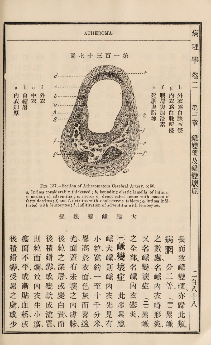 Fig. 137.~Section of Atheromatous Cerebral Artery, x日0. a, Tntima considerably thickenfd ; b, bounding elastic lamella of intirua; c. media ; d, adventitia ; e, necros cl denucleated tissue with masses of fatty detritus;/, and f, detritus with cholesterine tablets ; g, intima in扫!- trated with leucocytes ; h, infiltiration of adventitia with leucocytes. 症 a 變 « ® 大 ATHEROMA. h外衣爲白脉w侵 g內衣爲白騰所樣 f胸屑與胆渣素 e死網與脂塊 d外衣 C中衣 b肖縮層 a內衣加厚 長而致峨變硬、亦歸此親 病網分二集(1 )累峨 之數獻名峨內衣喩形氣 又名載變壞症(二)累峨 之全孤名峨巧衣塞炎、I I峨變壞症此多累總I 峨^^脈則峨內衣先見有 小做寬約一至千千分米、 蓉高於衣酿色灰而蓉透 张面蓋有未壞之內膚獻 /後髓之深欣或變白孰而 後積鎭繫或變軟成流或 則粒面齡教內衣生小款 瘍面不取或漸貼血齡或 後積鑛繫受累之獻或少 病理學卷一 第S章麵變硬巧麵變壞症 一百八十八