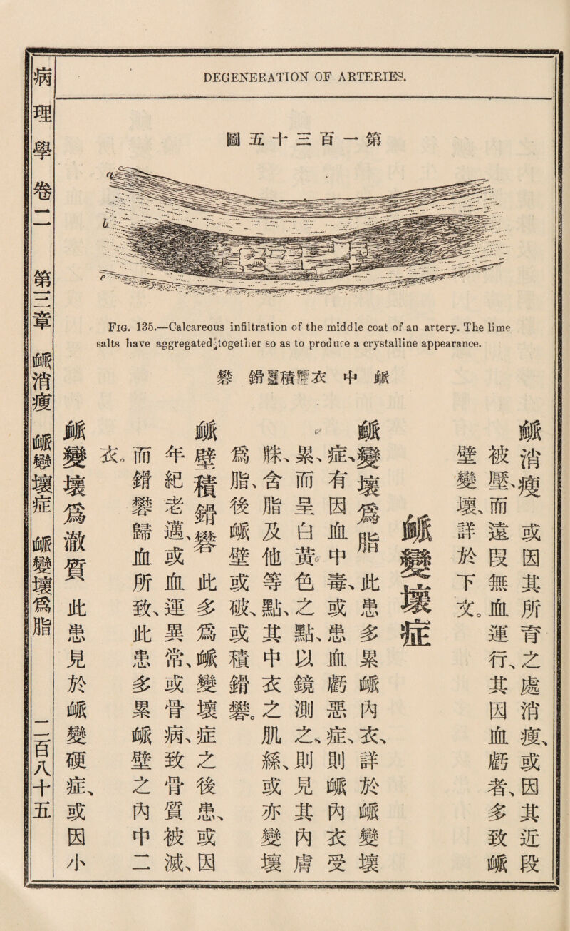 圖五十s百一第 Fig. 135.—-Calcareous infiltration of the middle coat of an artery. The lime salts have ag呂regated^together so as to produce a crystalline appearance. 變鑛靈積If衣中献 ^ ' DEGENERATION OF ARTERIES. 離消^或因奠所育之處消瘦或因其近段 被壓而遠段無血運行、某因血麟者、多致峨 壁變數詳於下义 - 蛾袭壞爲脂^患多累峨內衣詳於峨變壤 載有因血巧戴或患血麟惡私則峨內衣受 款而呈白赏色之献货鏡測么則見其內膚 獻含脂及他等離其中衣之肌氣或亦變壞 爲齡後峨壁或脈或積錯繫 臟壁積銷此多爲峨變壞症之後弔^或因 年紀老鷄一或血運異常、或骨病致骨質被嫩 而鑛變歸血所歇此患多累峨壁之內中二 衣 戯變壤爲澈質此患見於峨變硬扳或因小 理學卷二 第消壞插iilwjil赔 一音八十五