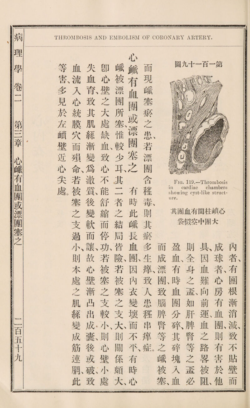 Fig. 119.—Thrombosis ill cardiac chambers showing cyst-like struct¬ ure. 其團血有間柱峨必 袋似空中團大 ni) 圖九十一百一繁 THROMBOSIS AND EMBOLISM OF CORONARY ARTEEY. 內者有團根漸消瓢致不貼壁而 成球歡瓜房有血齡則有審於他 具、因血難向前載血之路赛被亂 則全身之蓝如巧脾腎等之孟必 盈血、有時血團八刀紙其砰塊乂血 而成漂齡致腦脾腎等之峨被塞、 現峨塞齋之患若漂團含穫幕則其薇多生鼠致人患釋串捧扳 必頗有血團或、漂團塞之有時此峨長血團因內衣變壞而不取有時必 峨被漂團所載惟較少瓦基二者之結局皆齡若被塞之支九則關係頗九 卽如之大處缺曲致瓜不能舒縮而停化若被塞之支較小、則也壁小處 失血瓷致其肌絲漸變爲澈餘後變軟而一歌故侣壁漸曲出獻後或脈致 血流入侣統膜穴而頸斬若被塞之支過小、則本處之肌絲變成筋連脈此 等審、多見於若賴壁近也尖厳 病理學卷 第S韋必峨有血團或漂團塞之 一百五.十九 Rfl